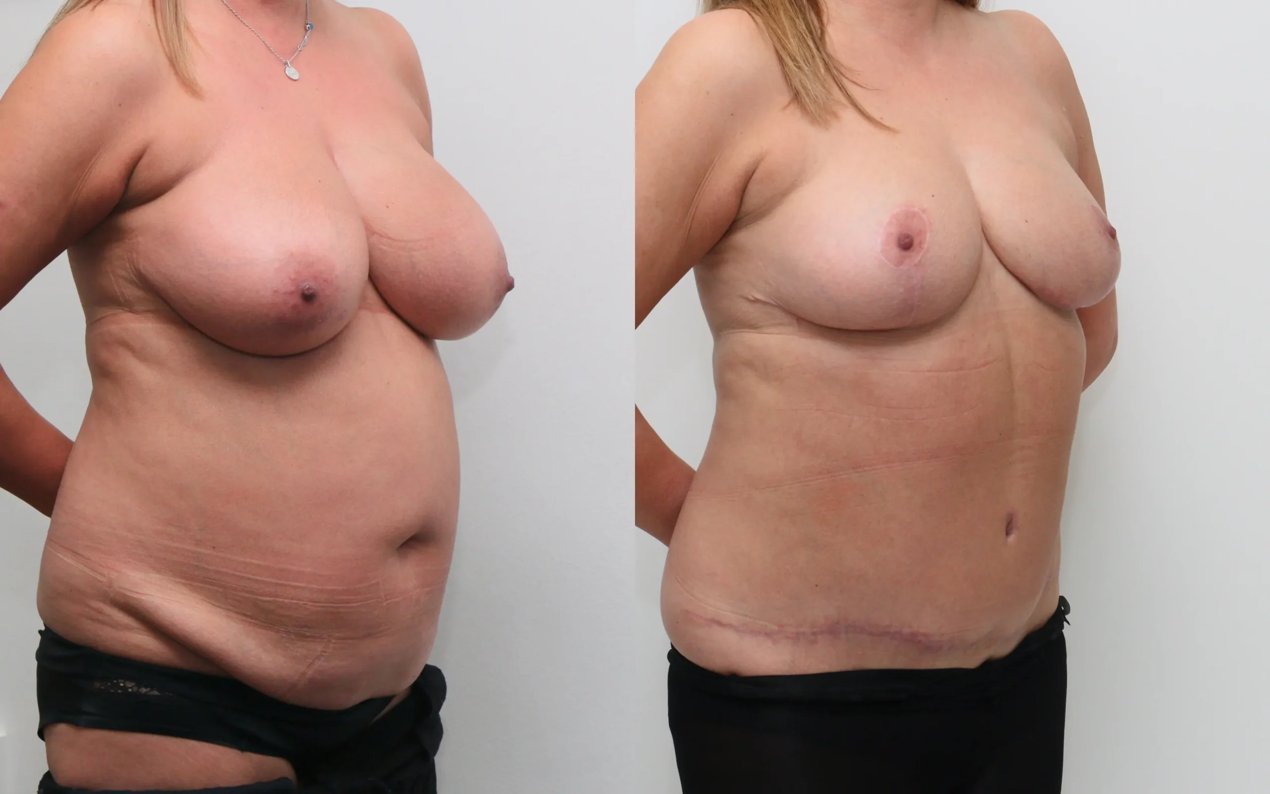 Breast reduction and full tummy tuck