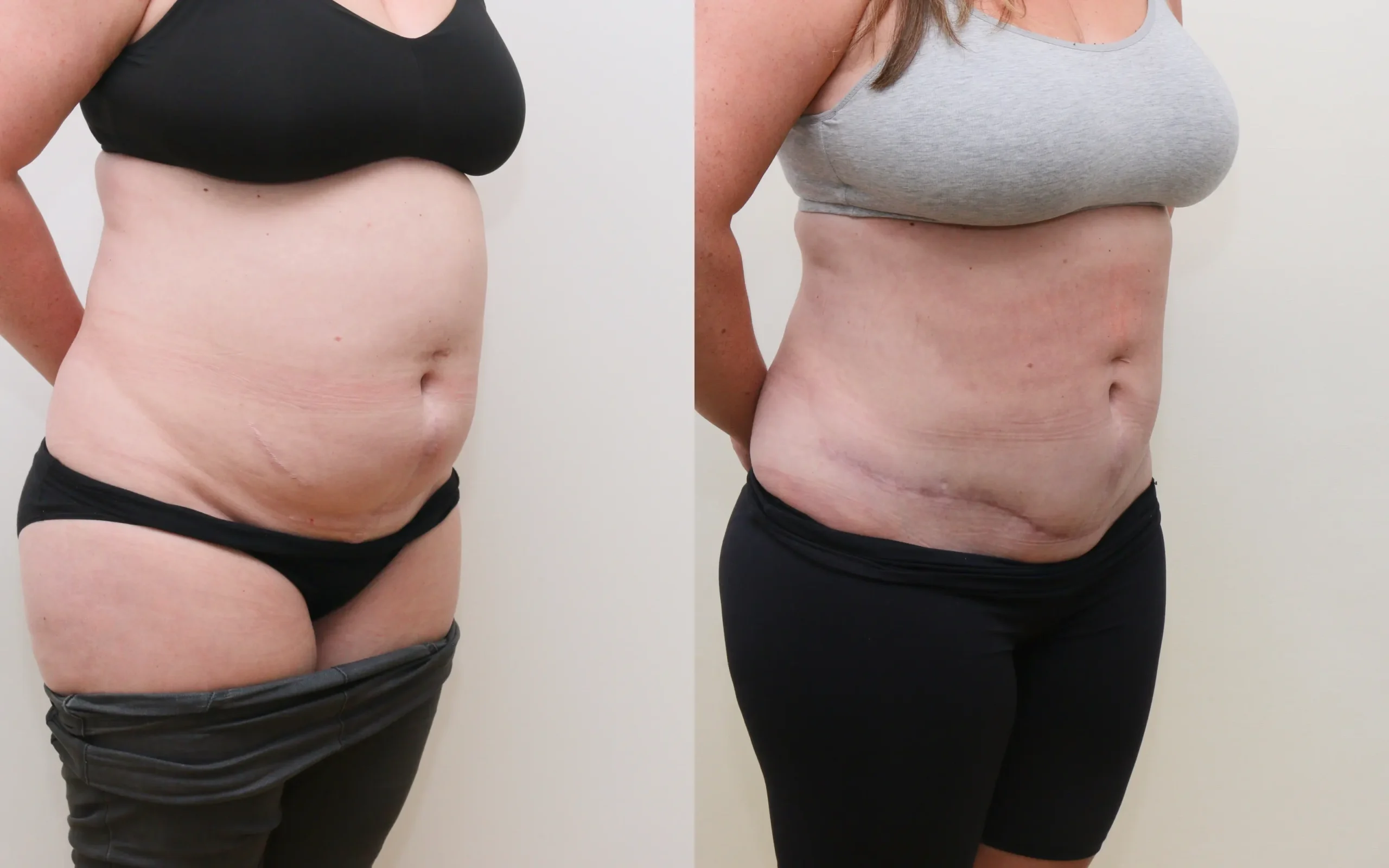 Mini tummy tuck plus lipo