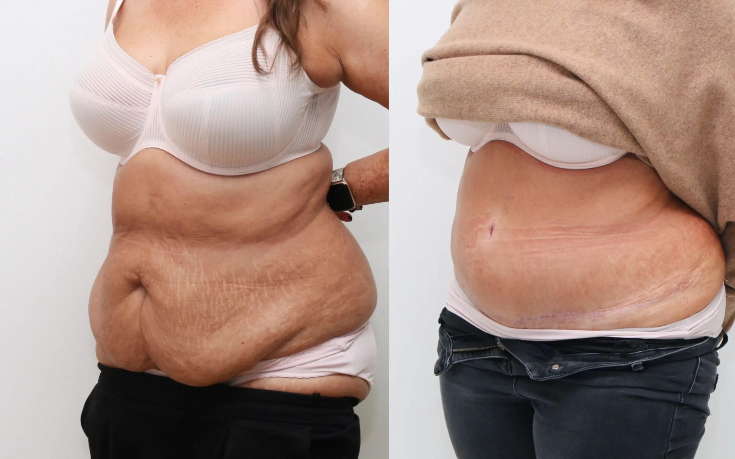 Full tummy tuck plus lipo