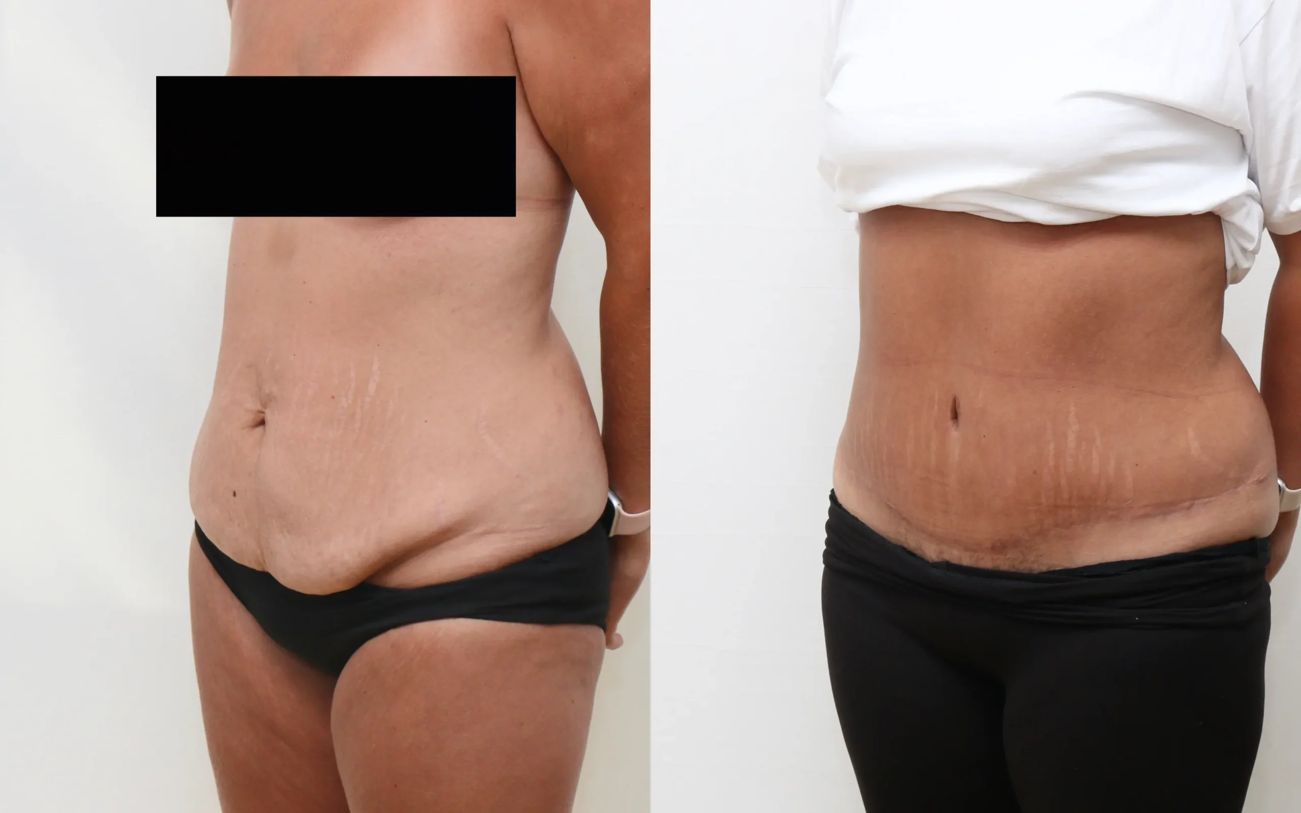 Tummy tuck before and after