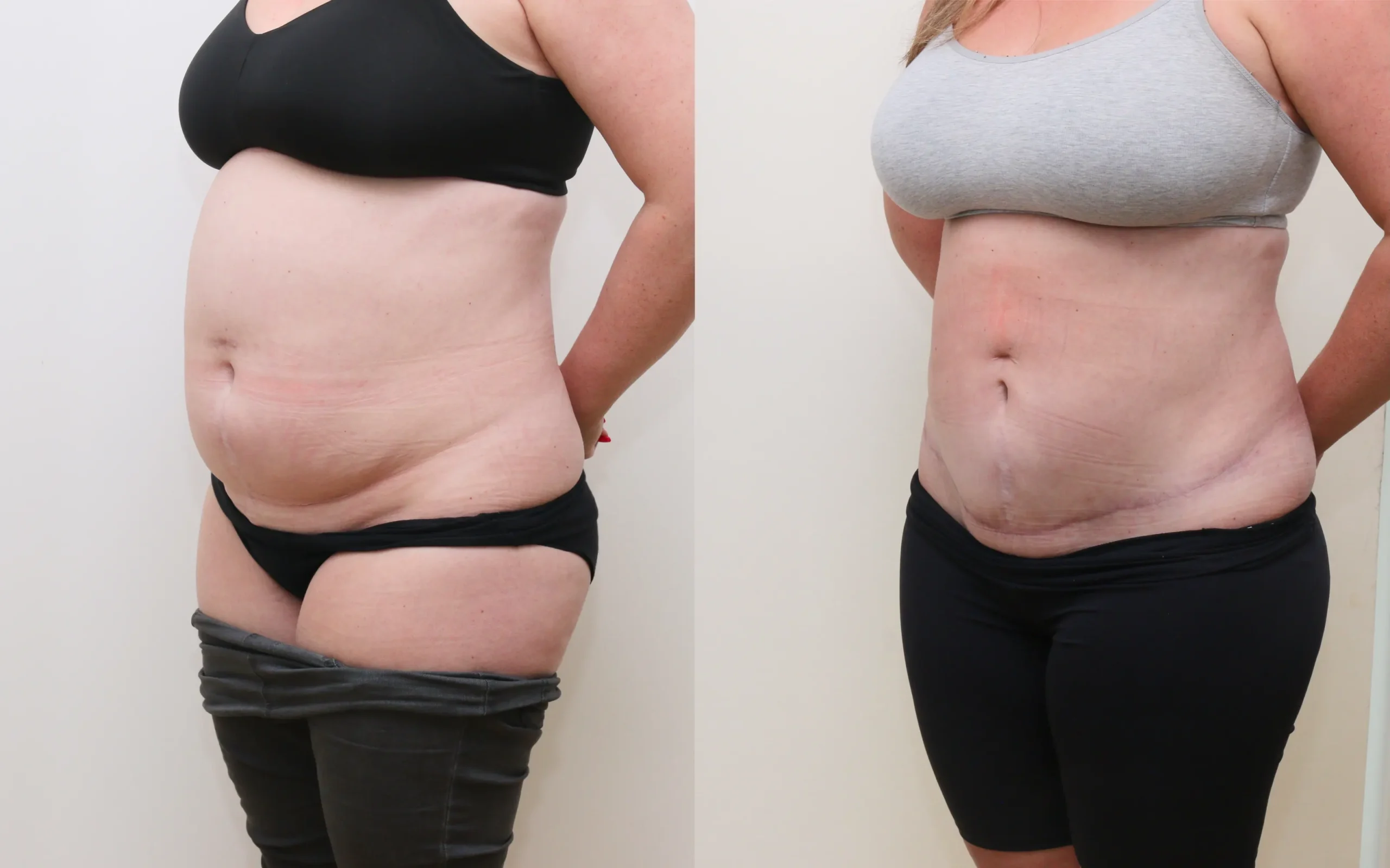 Mini tummy tuck plus lipo