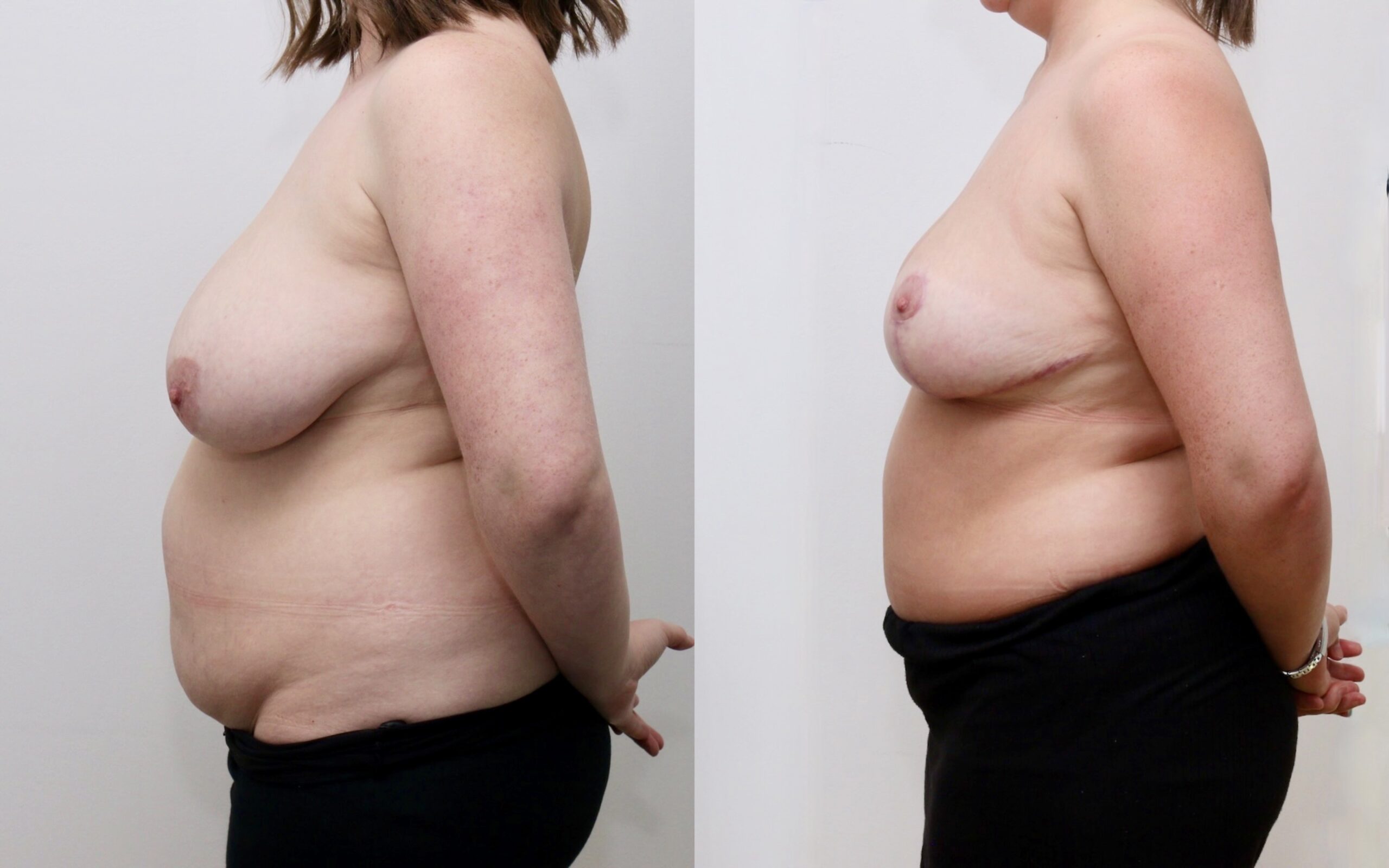 Tummy tuck and small breast reduction/ uplift