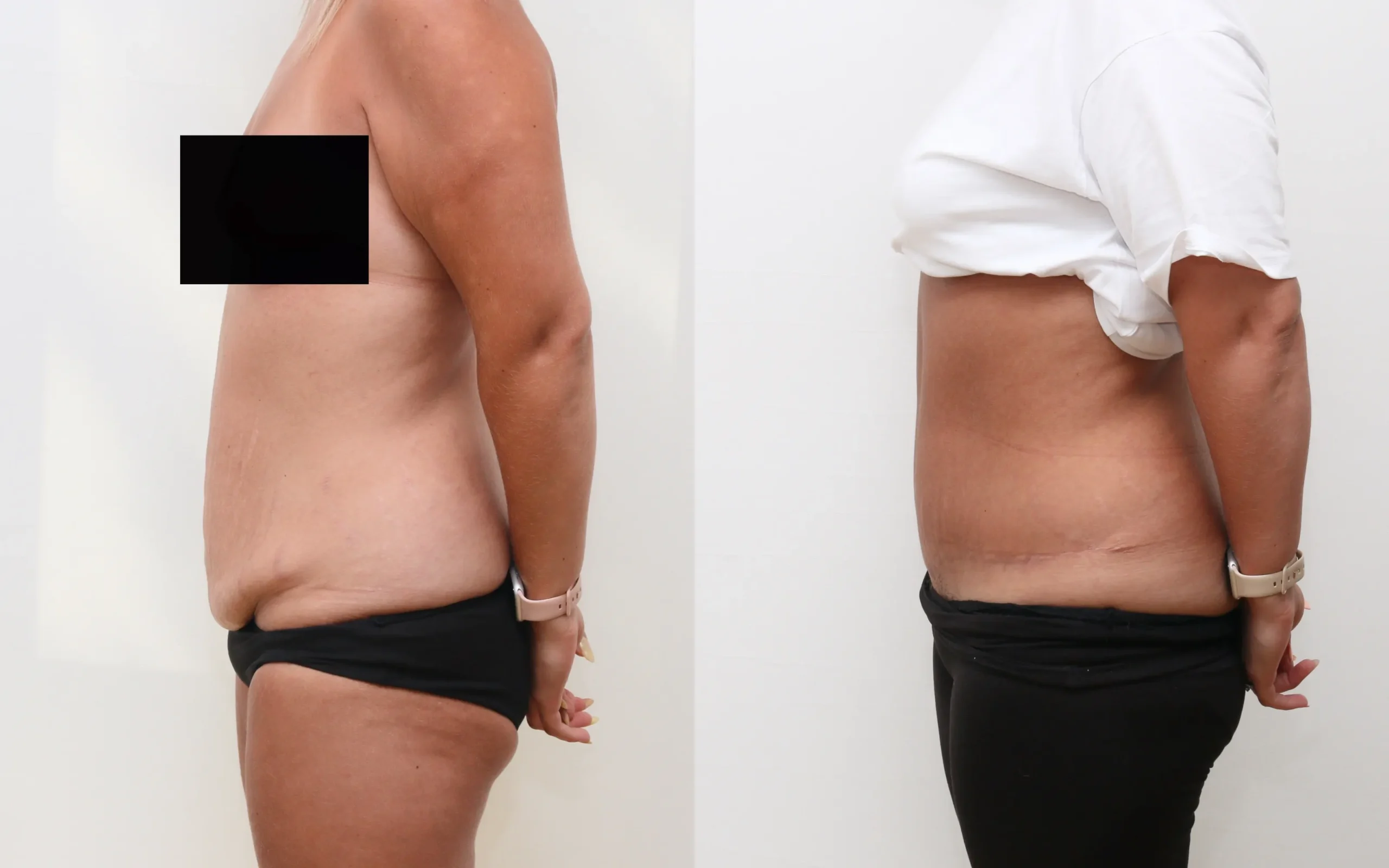 Tummy Tuck Before and After Photos