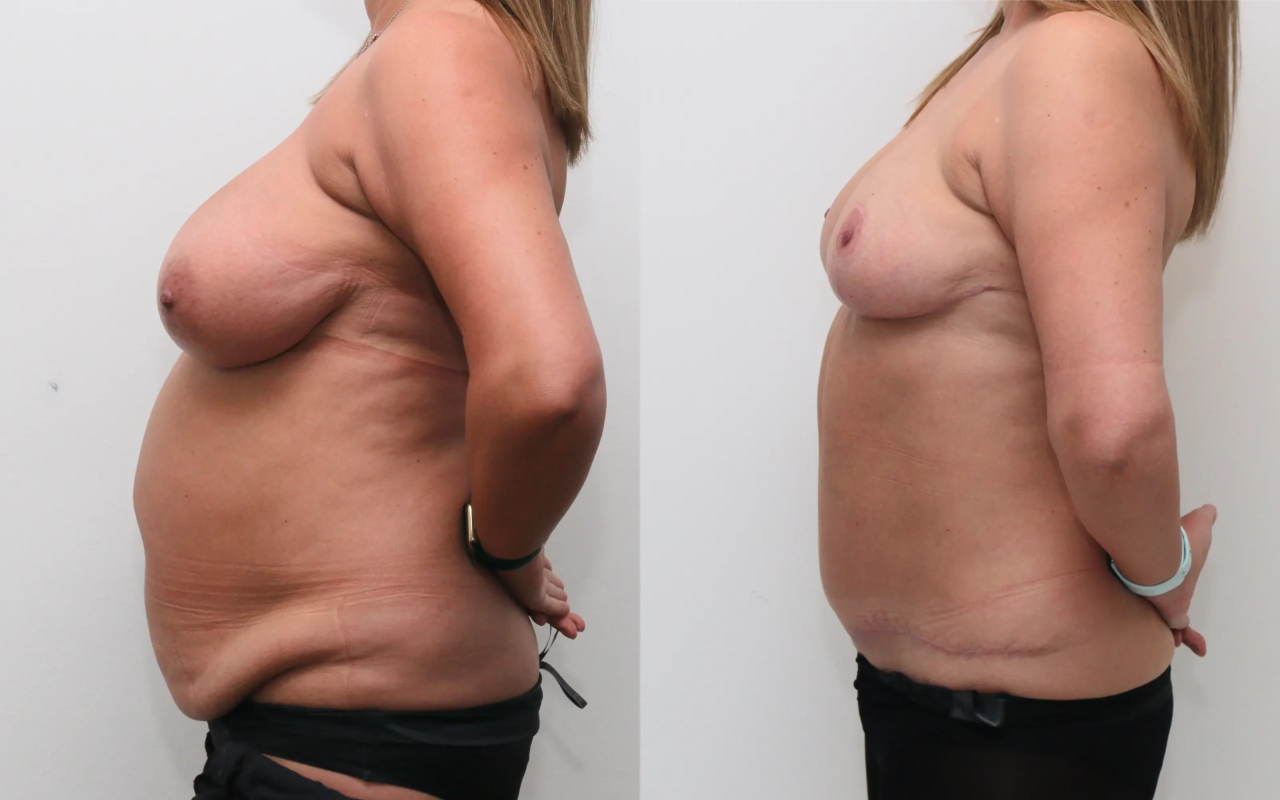 Breast reduction and full tummy tuck
