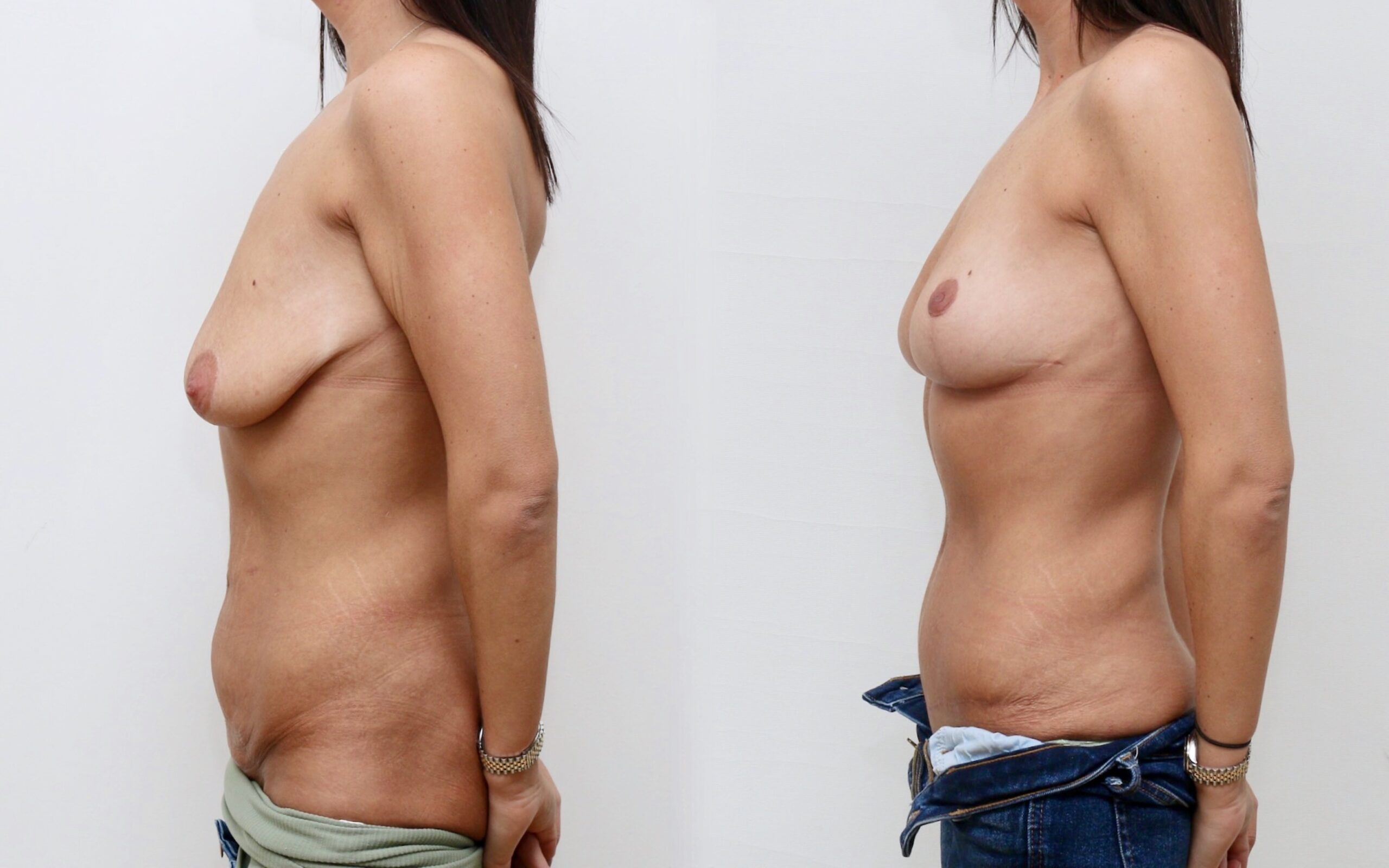 Post gastric sleeve tummy tuck and breast uplift