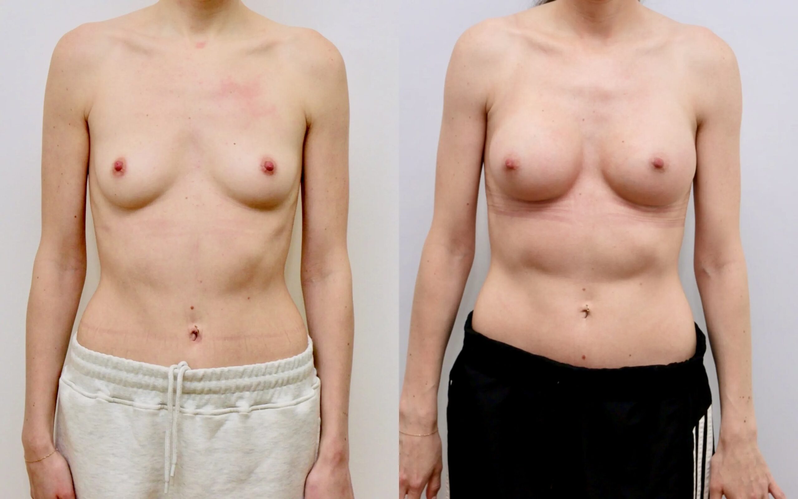 breast augmentation before and afters