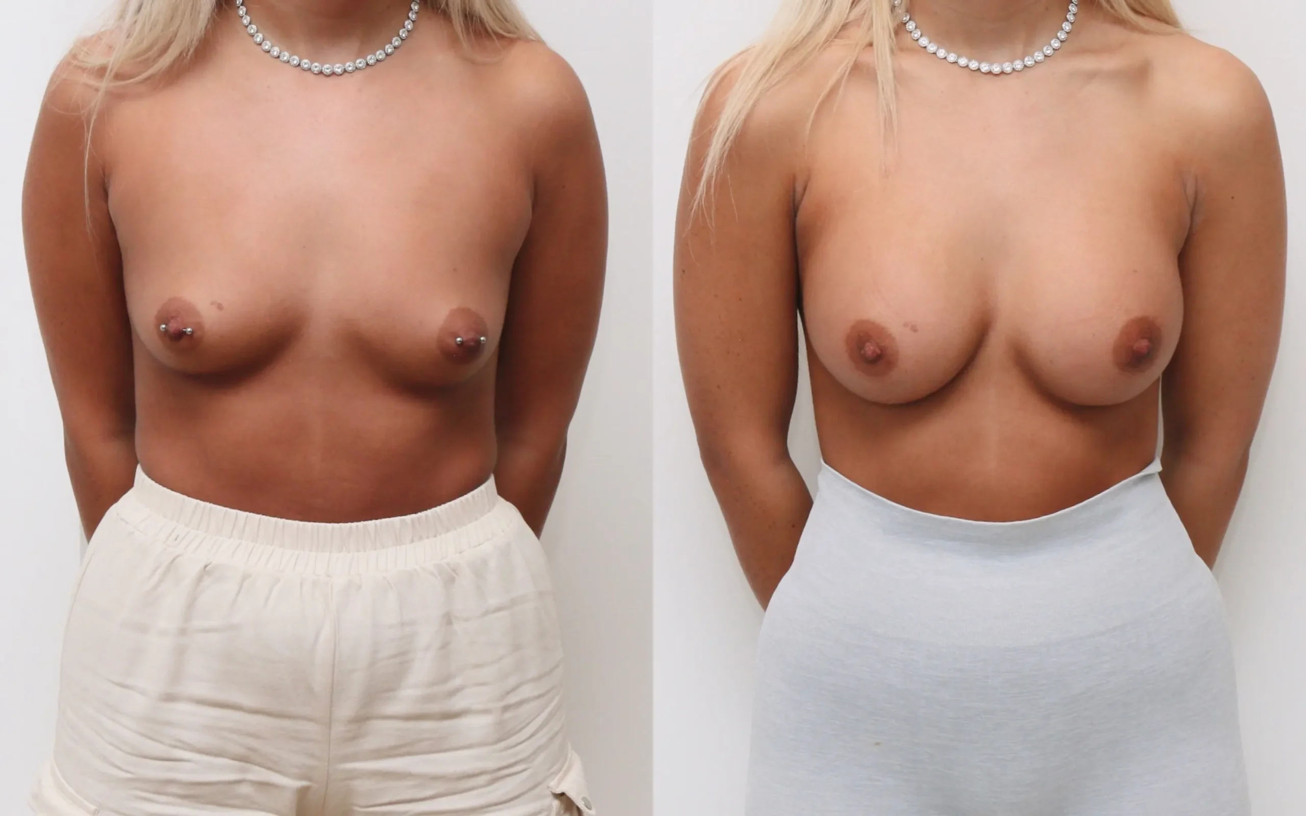 breast implants
