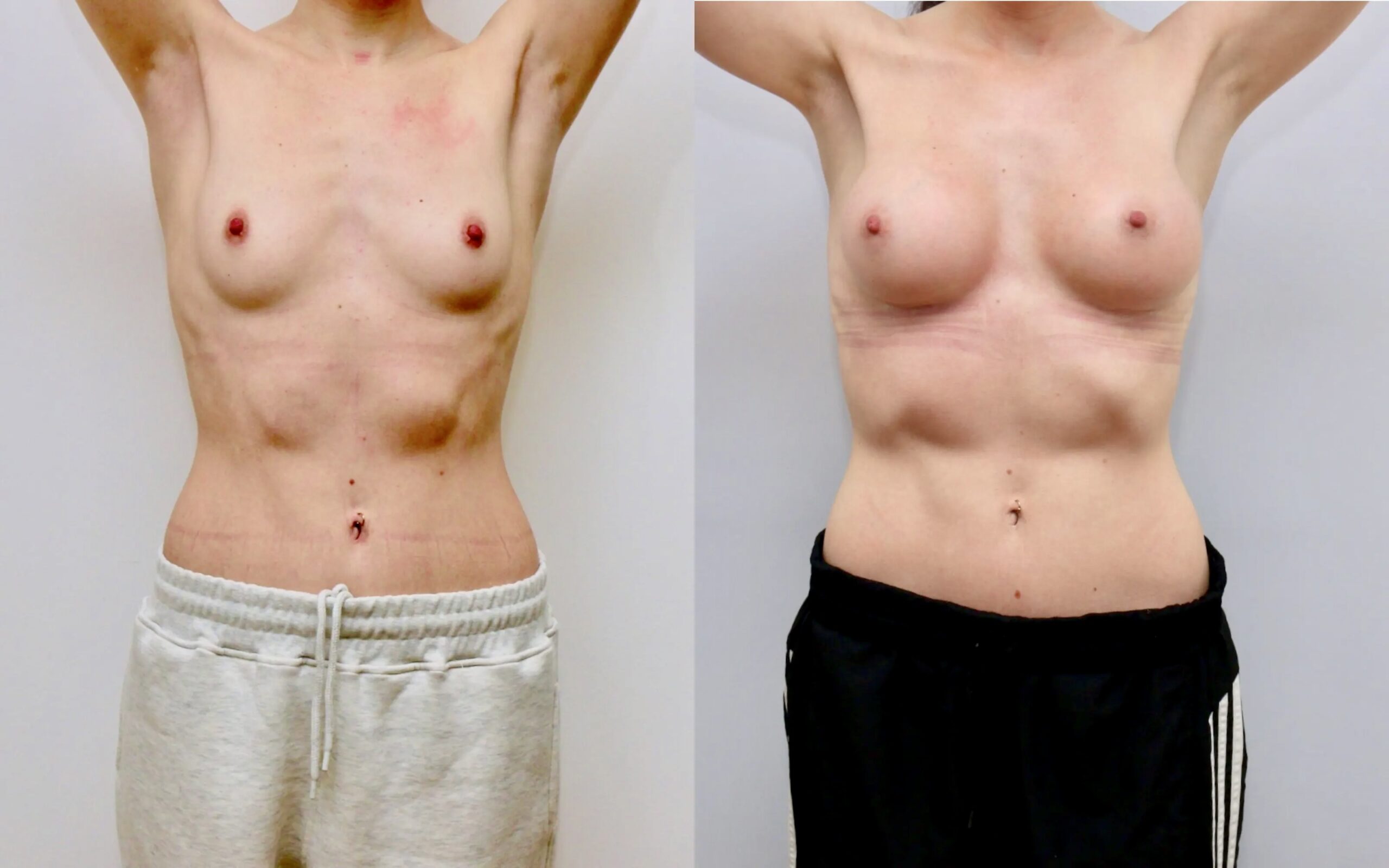 Breast implants scotland before and after — Quaba Plastic Surgery, photo 6 of 6