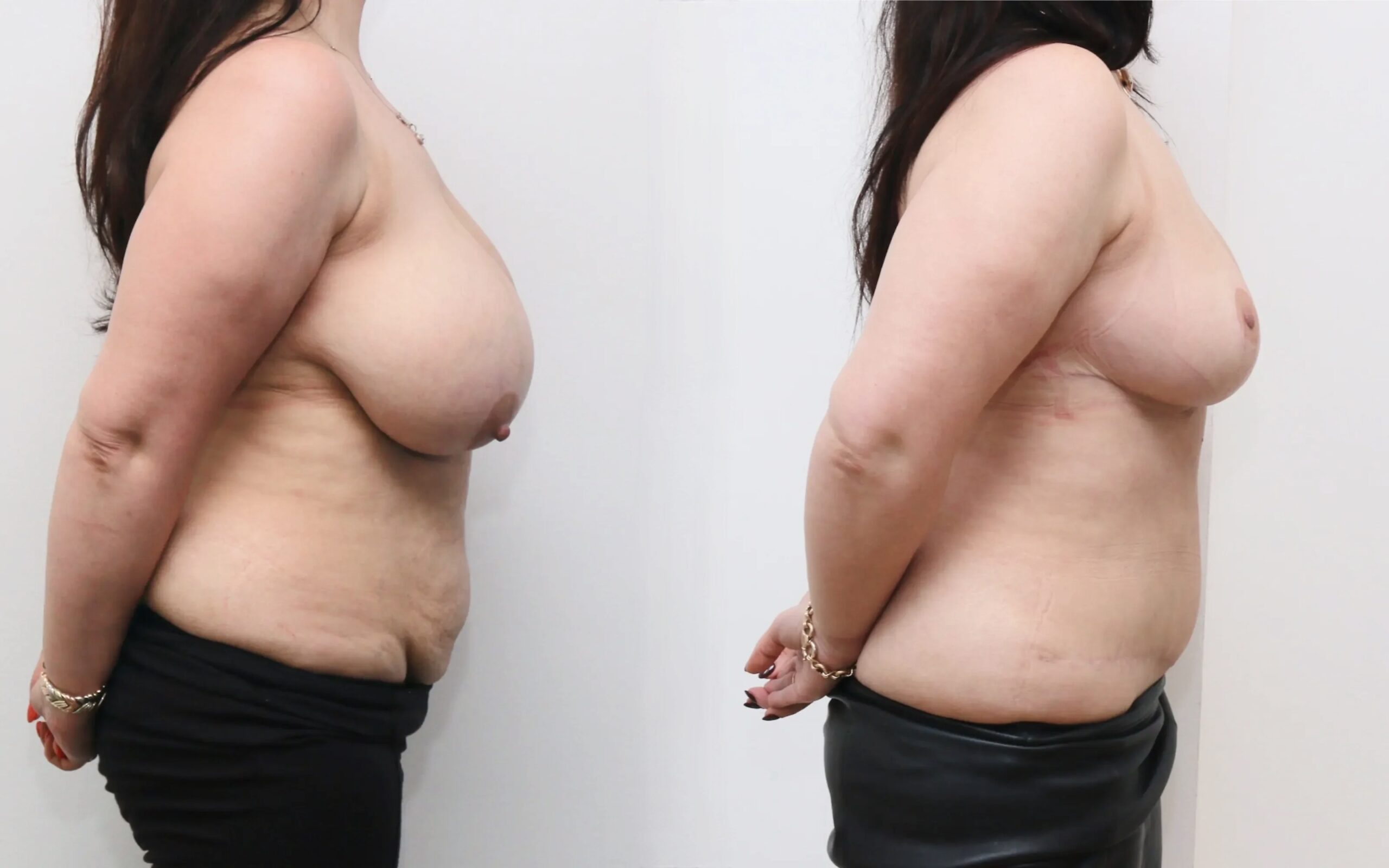 Full tummy tuck and breast reduction