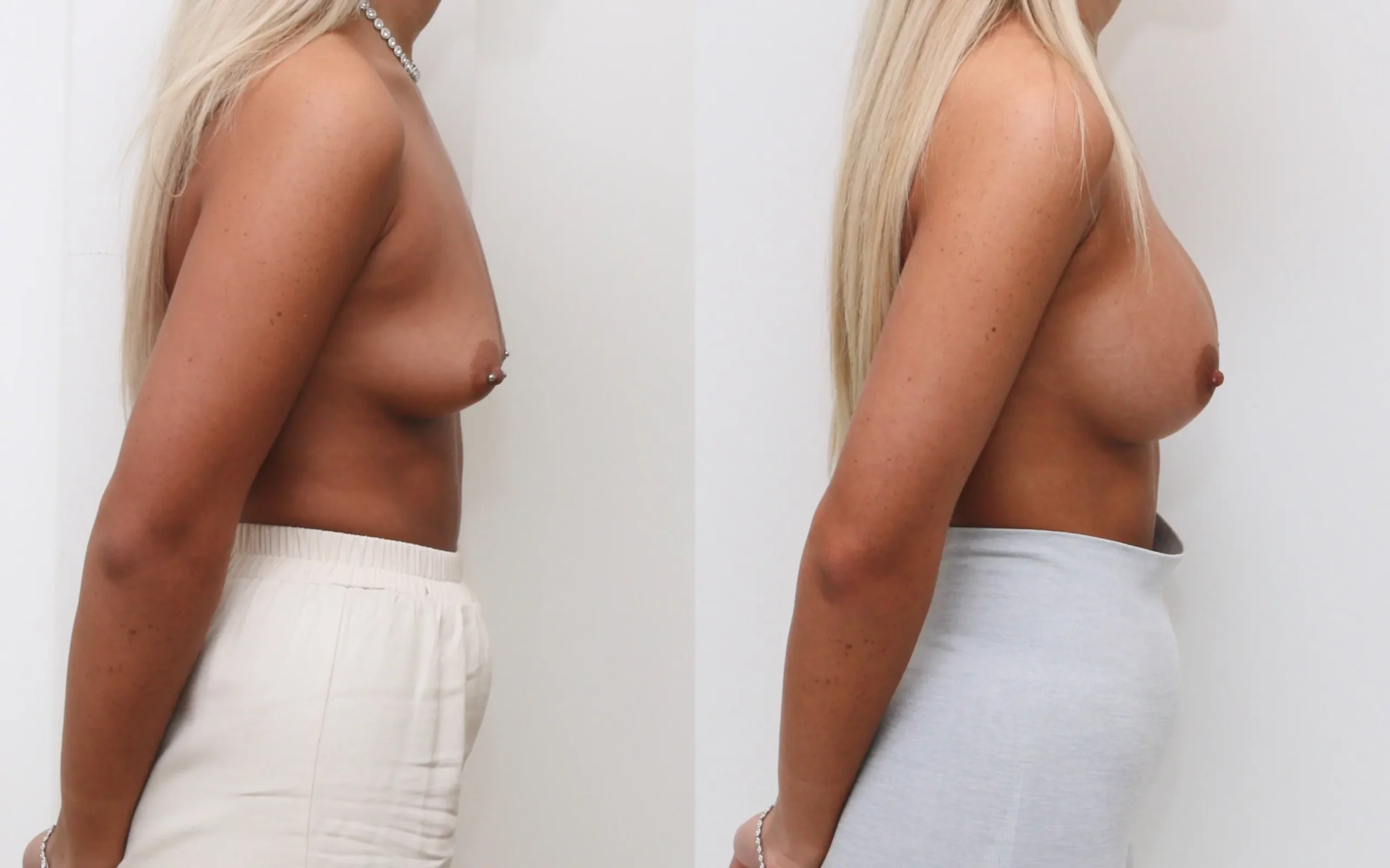 Breast augmentation 335cc DP before and after — Quaba Plastic Surgery, photo 5 of 6