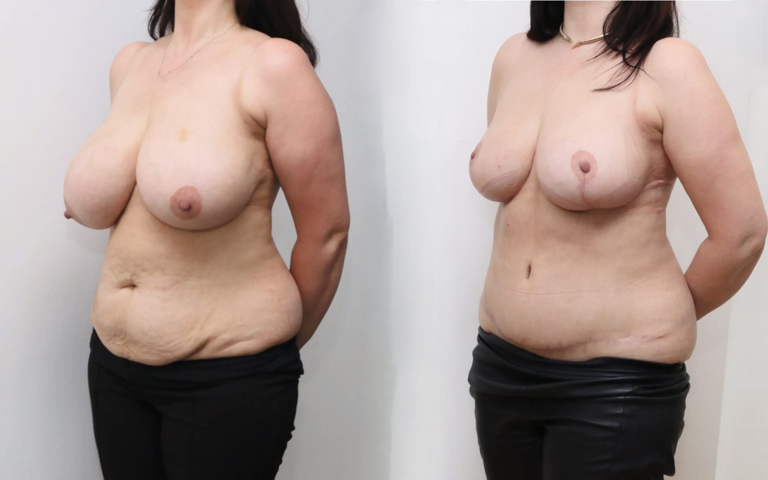 Full tummy tuck and breast reduction