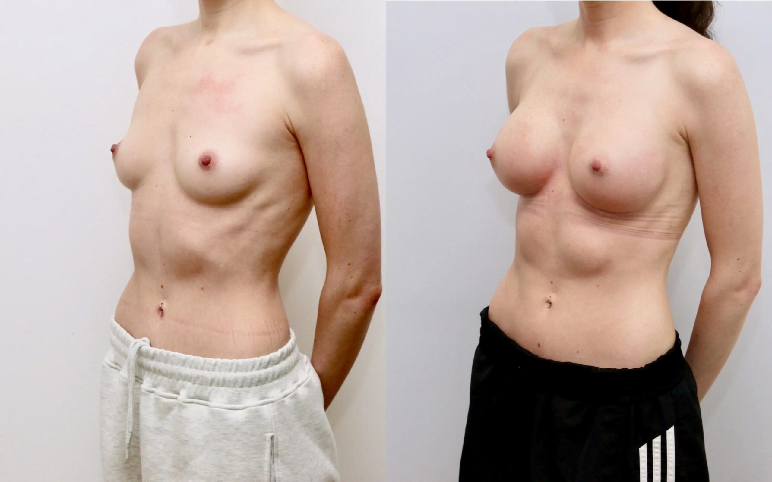 Small volume breast augmentation