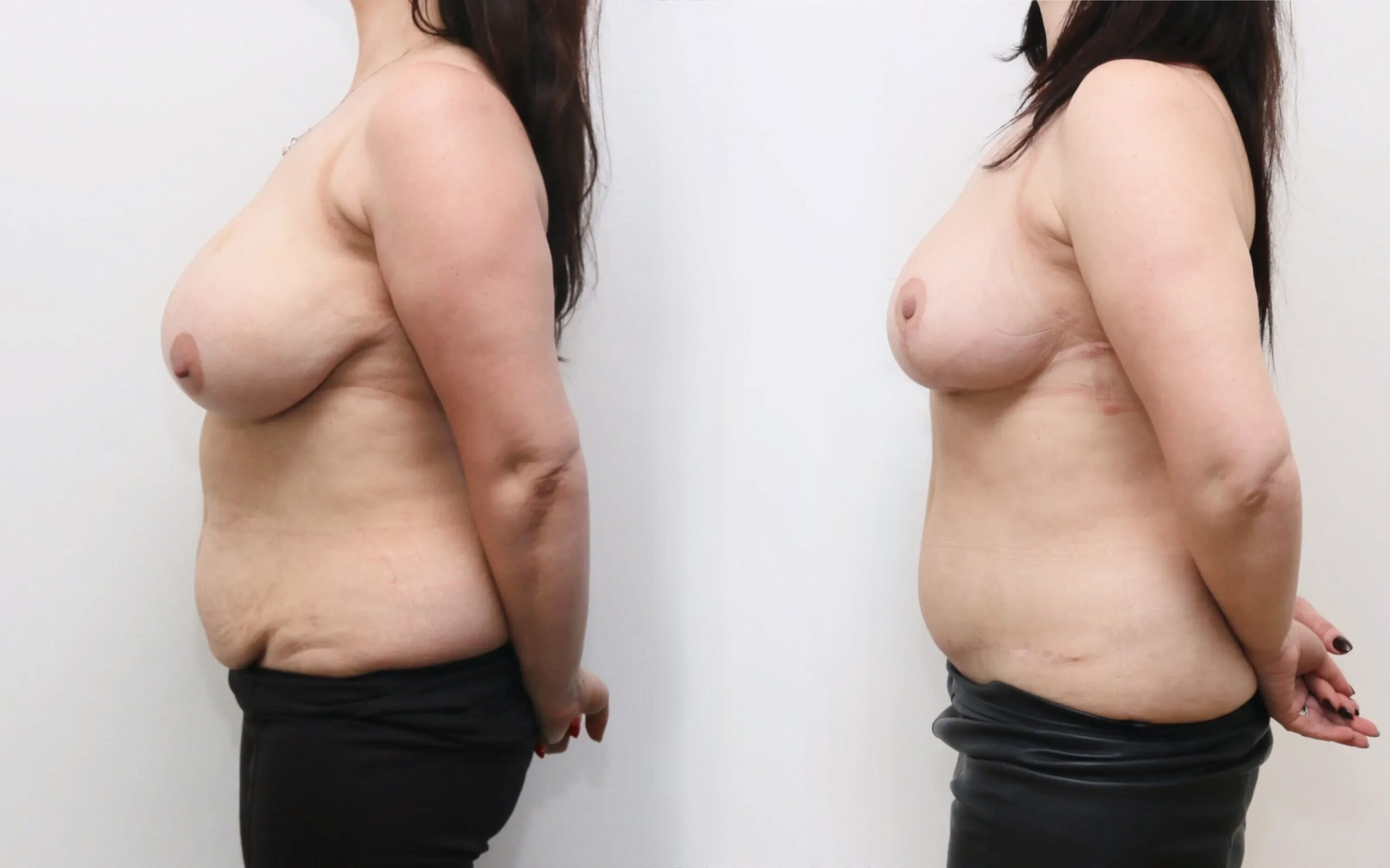 Full tummy tuck and breast reduction