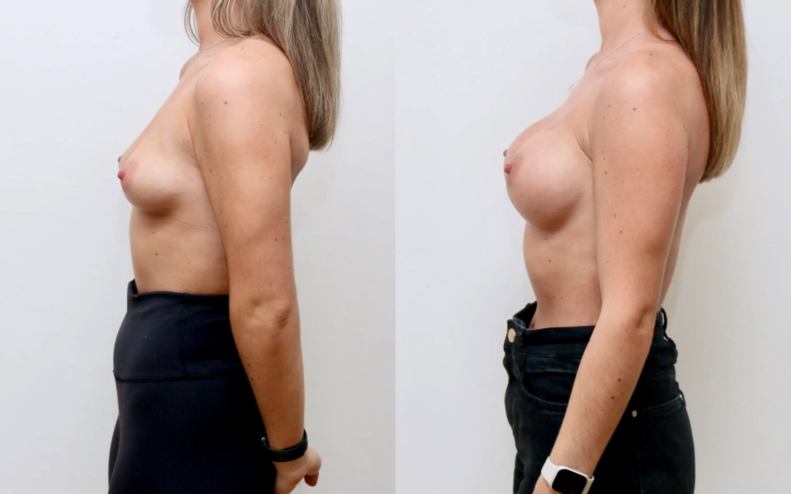 Breast augmentation before and afters