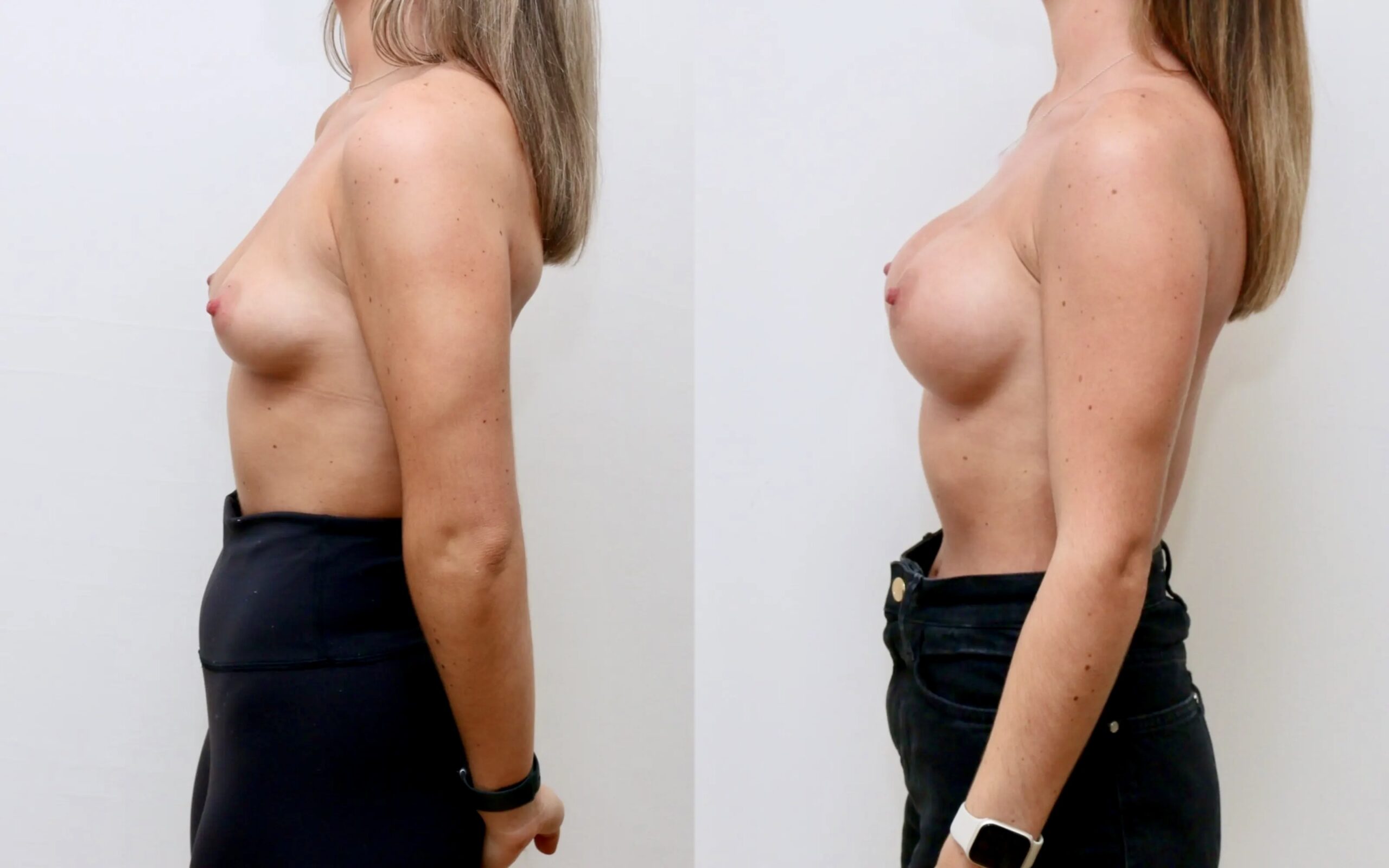 Breast implants scotland before and after — Quaba Plastic Surgery, photo 5 of 5