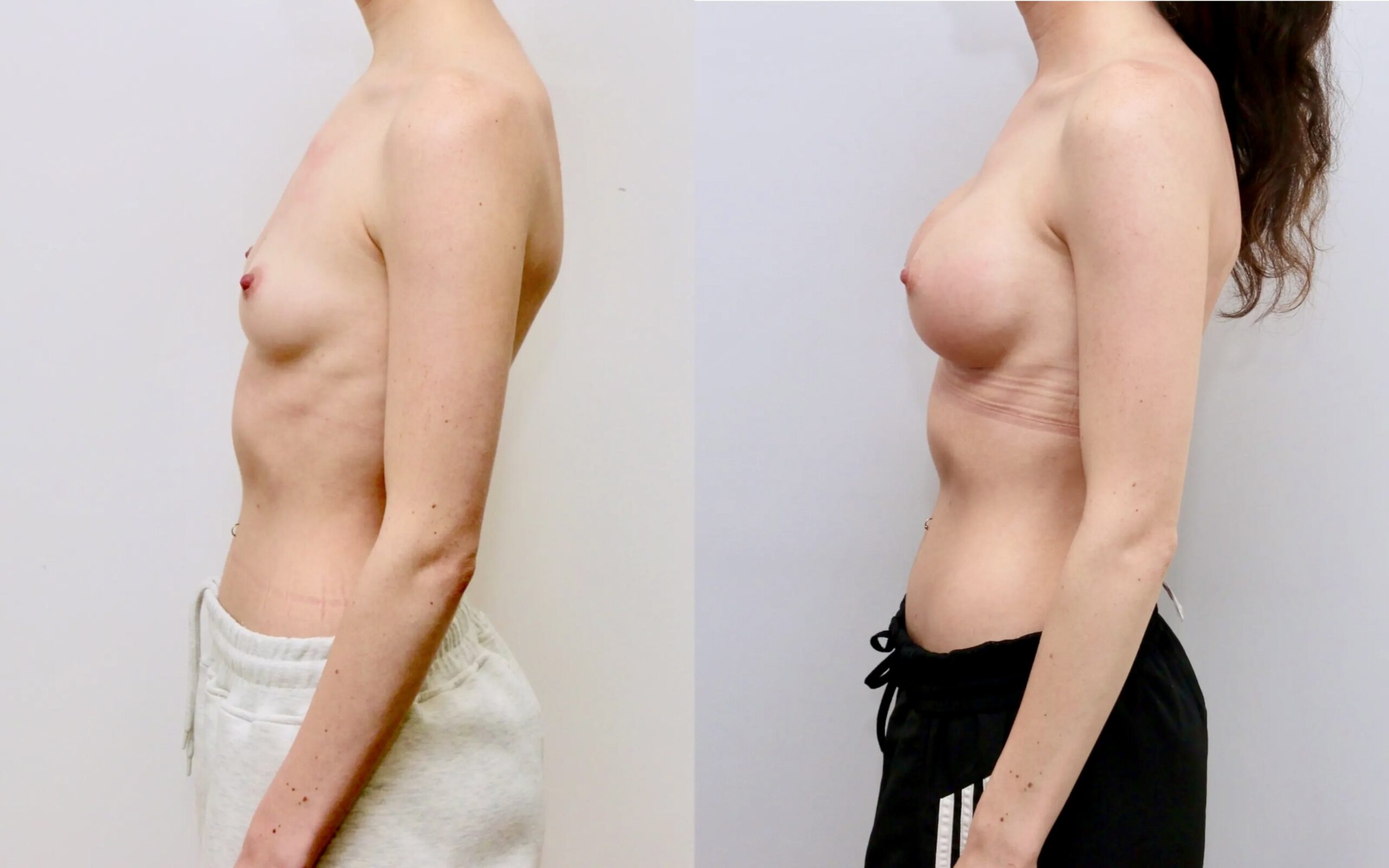 Small volume breast augmentation