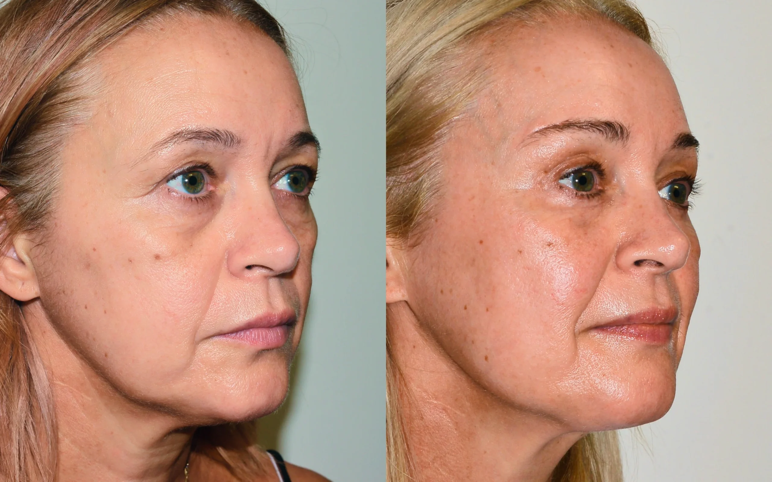 Direct brow lift and eyelid surgery