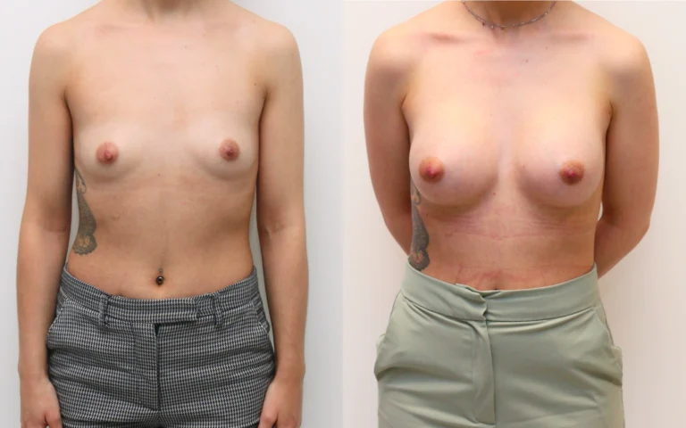 Breast augmentation: 275cc implants before and after, photo 1 of 6