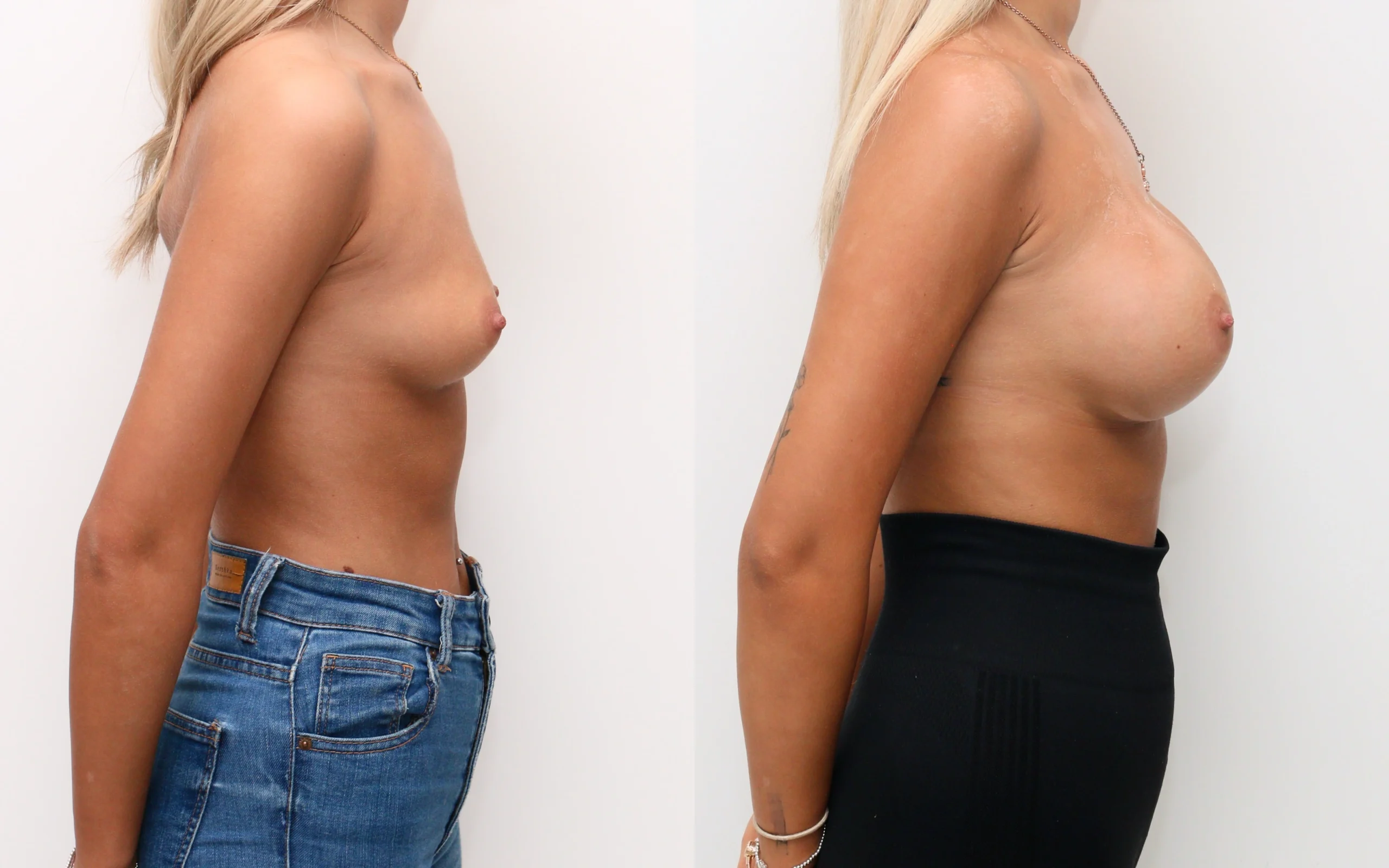 Breast enhancement 18 yr old before and after — Quaba Plastic Surgery, photo 2 of 5