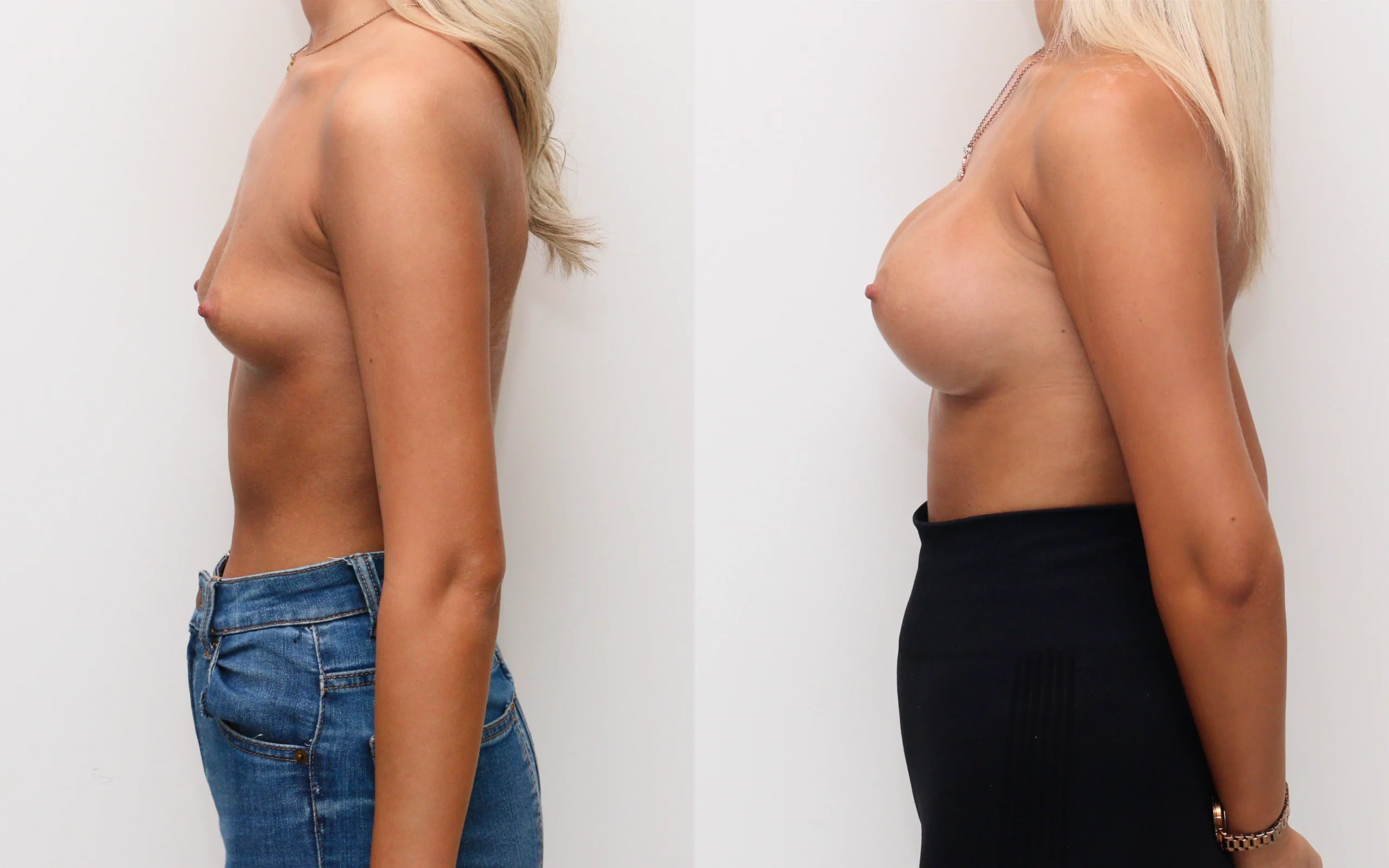 Breast enhancement 18 yr old before and after — Quaba Plastic Surgery, photo 5 of 5