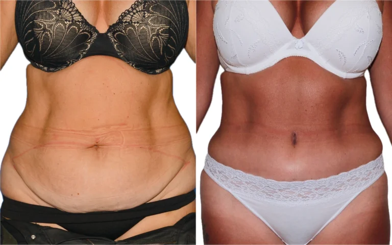 Tummy tuck plus 360 liposuction before and after, photo 1 of 4