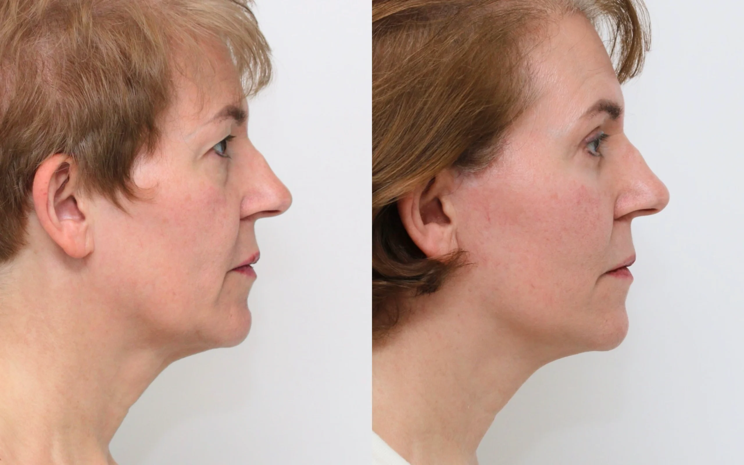 Facelift and eyes before and after — Quaba Plastic Surgery, photo 3 of 5