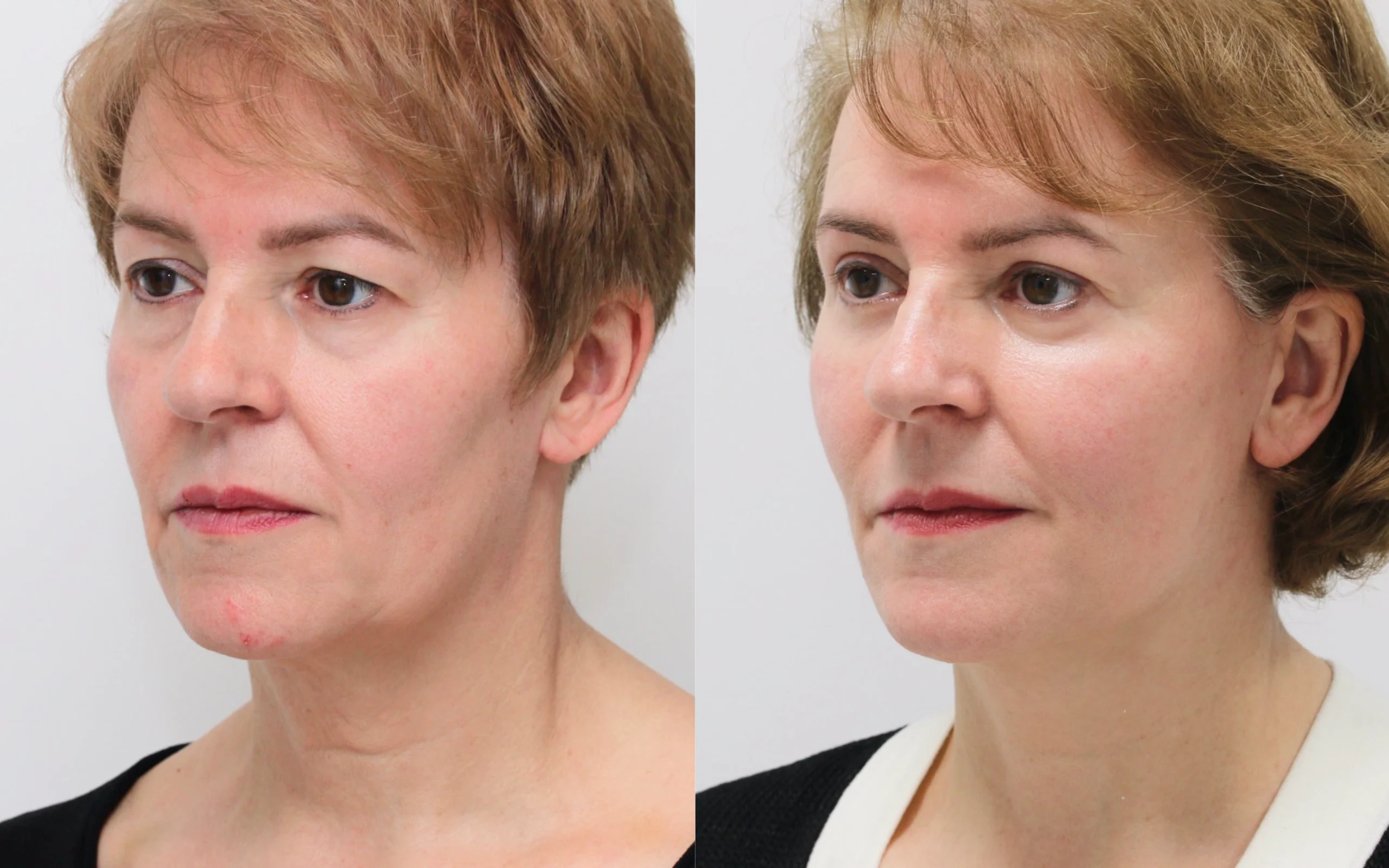 Facelift and eyes before and after — Quaba Plastic Surgery, photo 4 of 5
