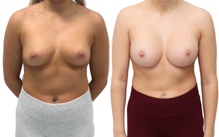Subfascial breast augmentation above the muscle, before and after, photo 1 of 5