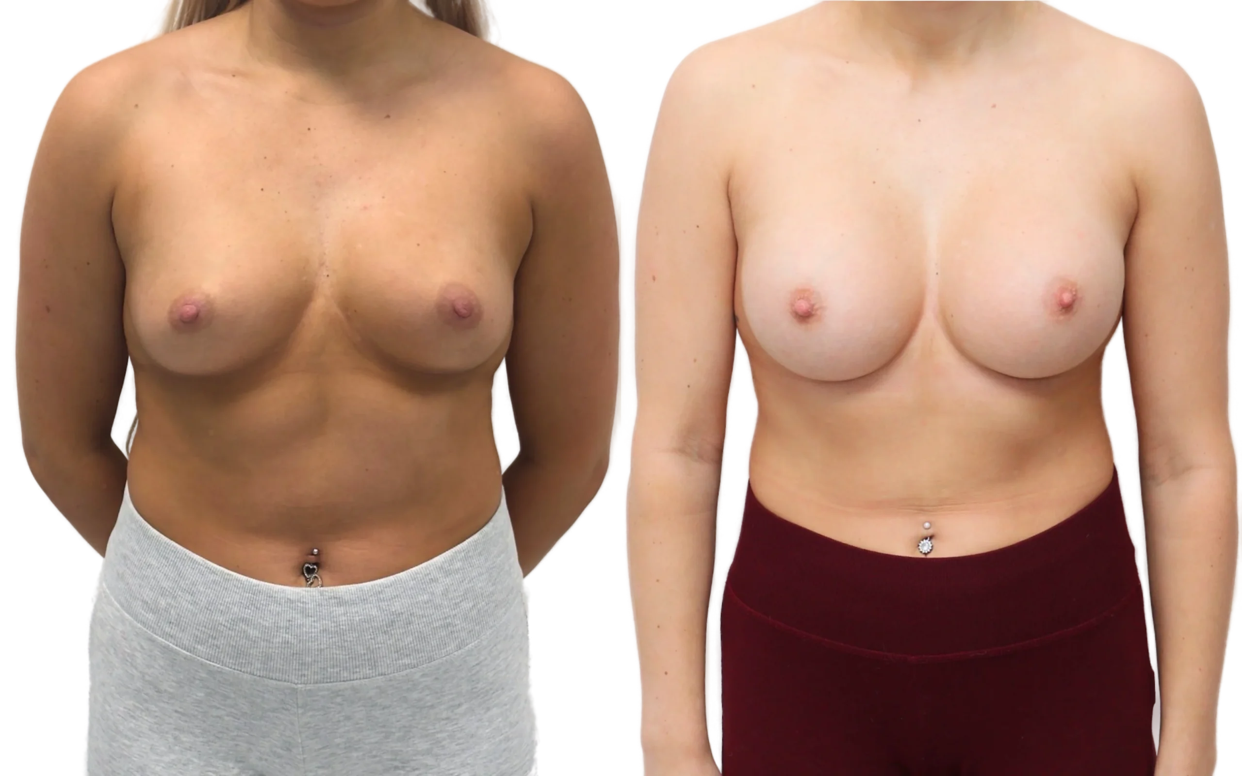 subfascial breast augmentation above the muscle