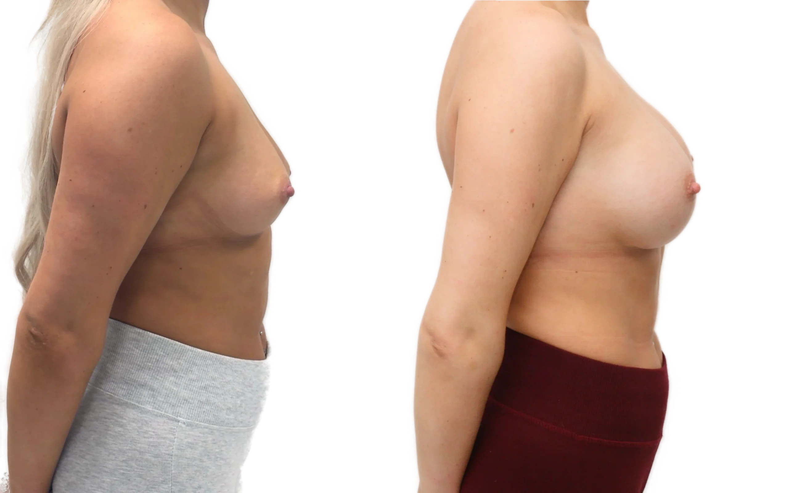 subfascial breast augmentation above the muscle