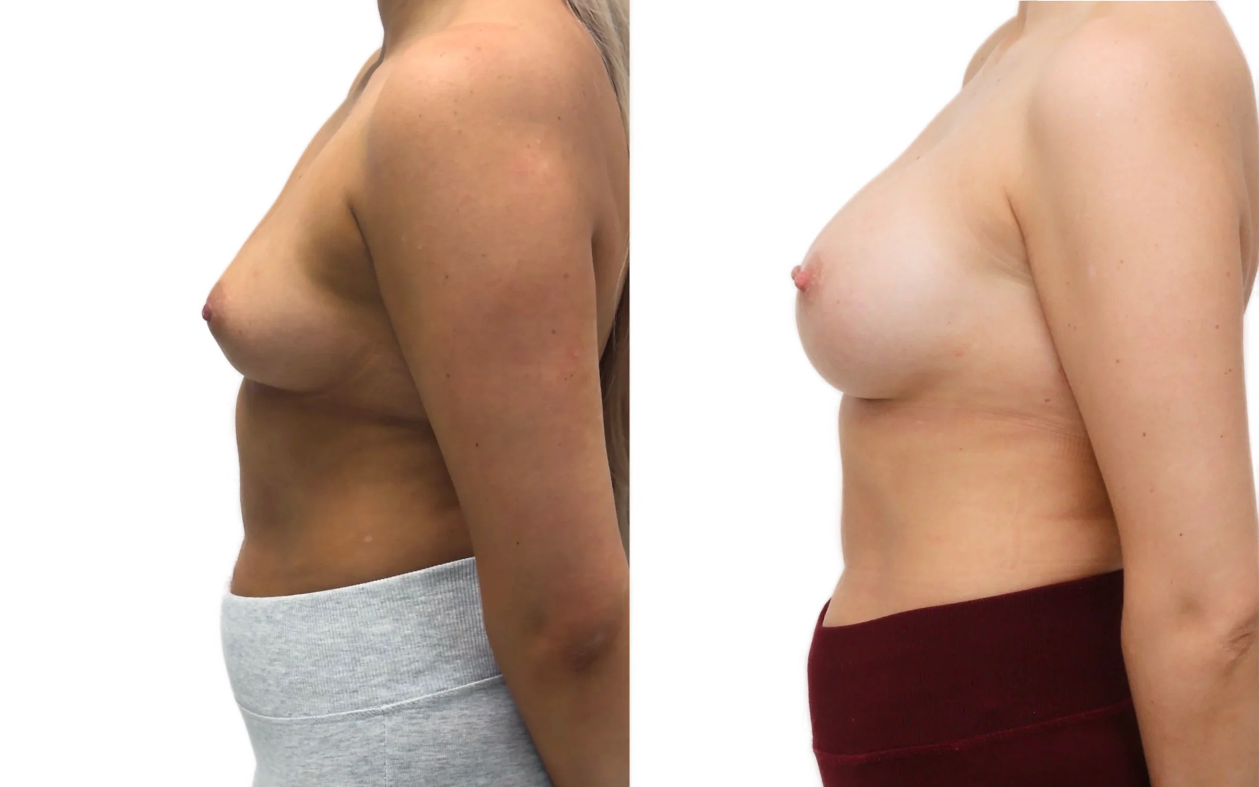 subfascial breast augmentation above the muscle