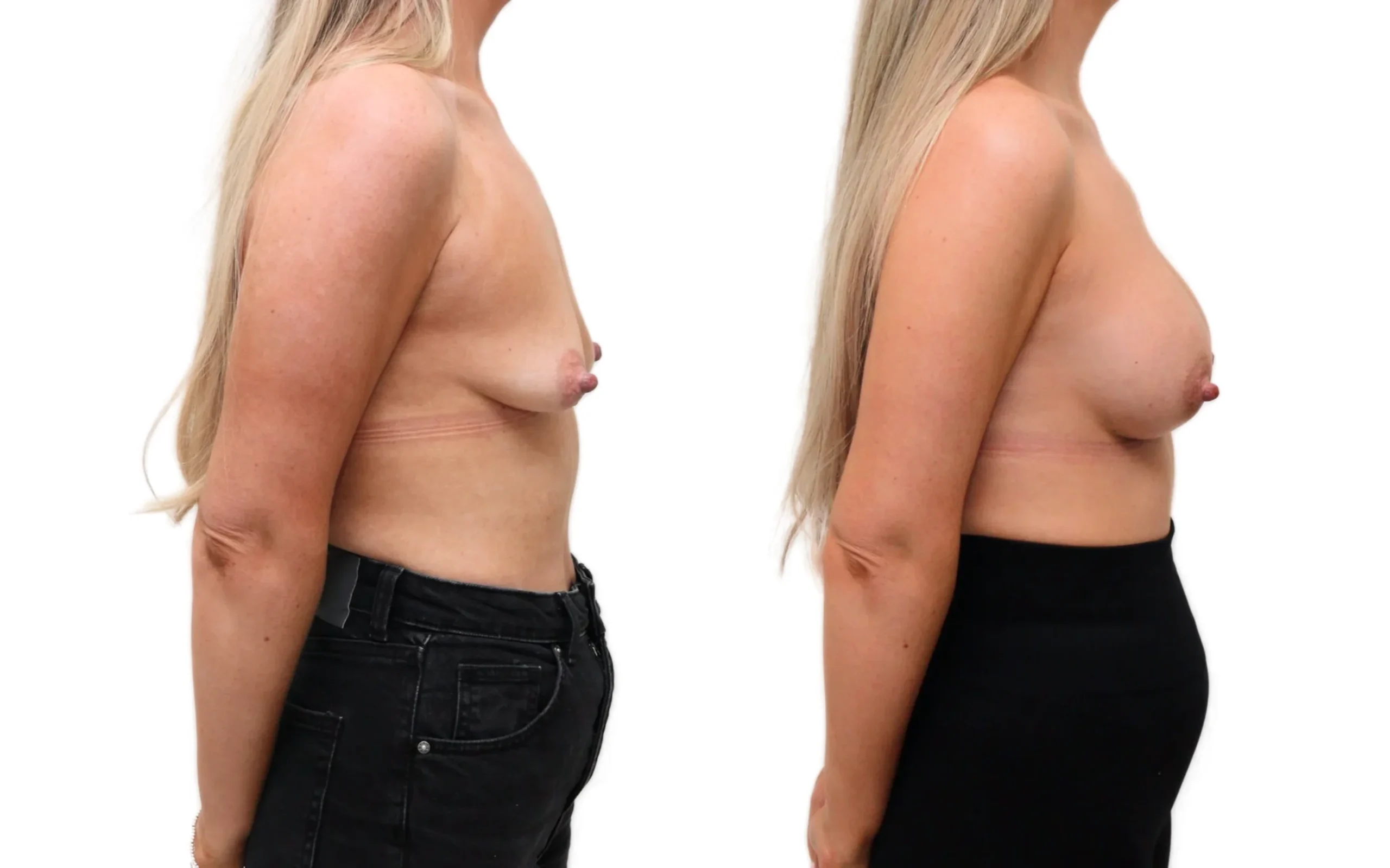 Beautiful Subfascial Breast Augmentation: Restoring Post-Pregnancy Volume