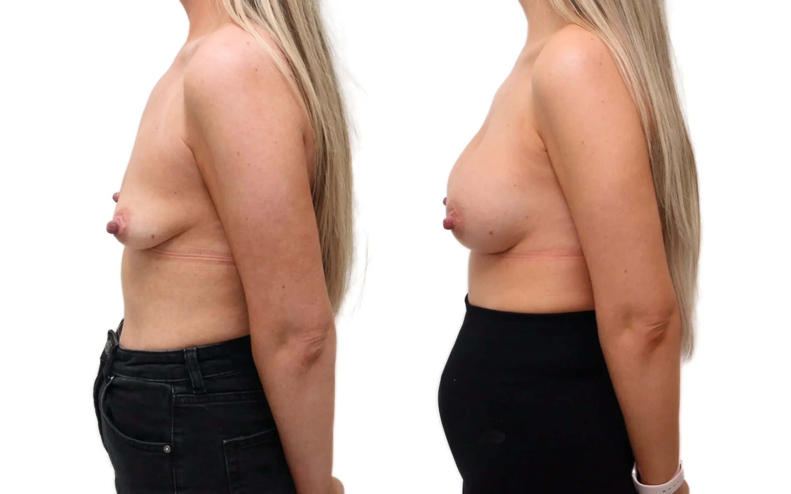 Beautiful Subfascial Breast Augmentation: Restoring Post-Pregnancy Volume