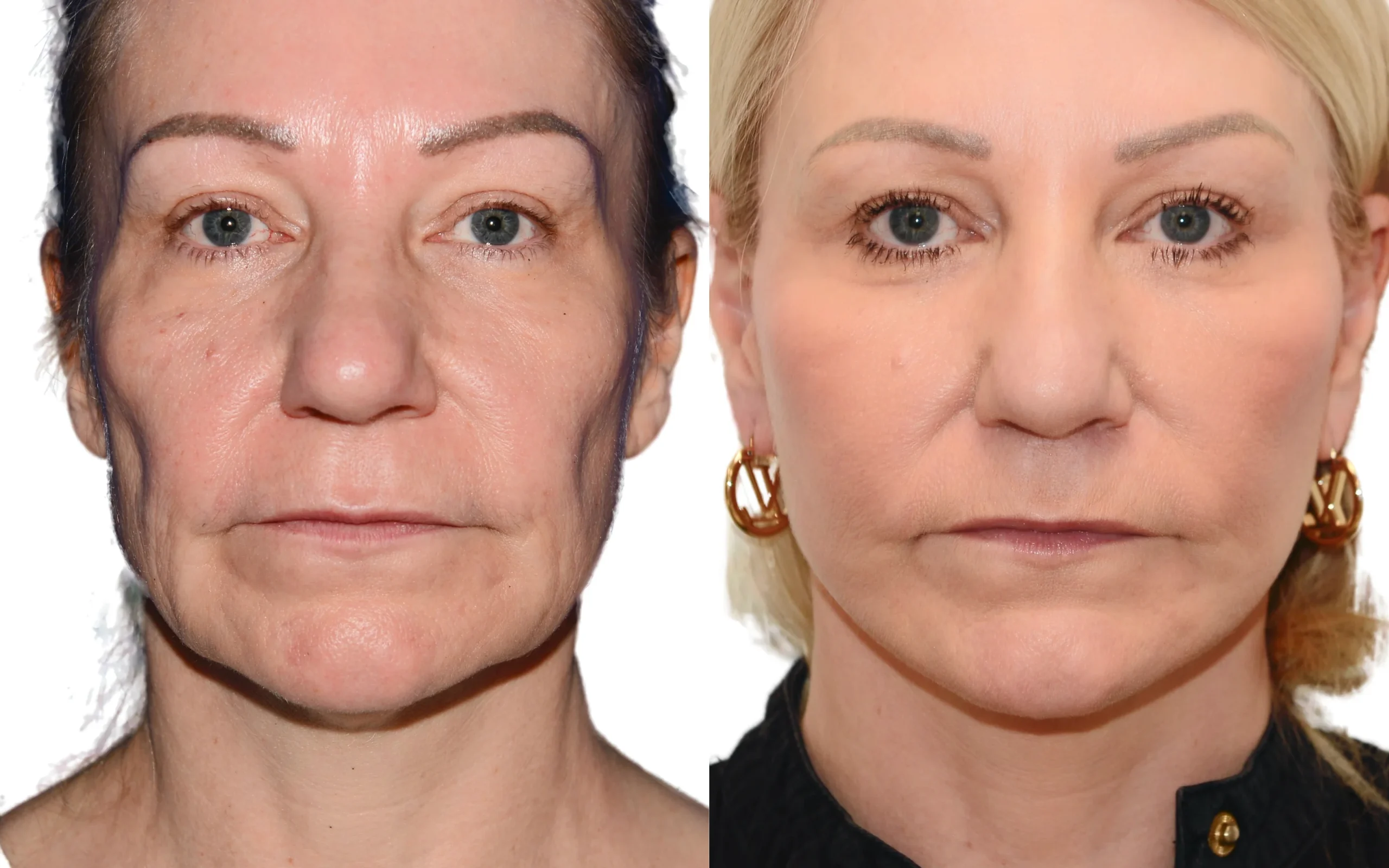 lower face neck lift scotland