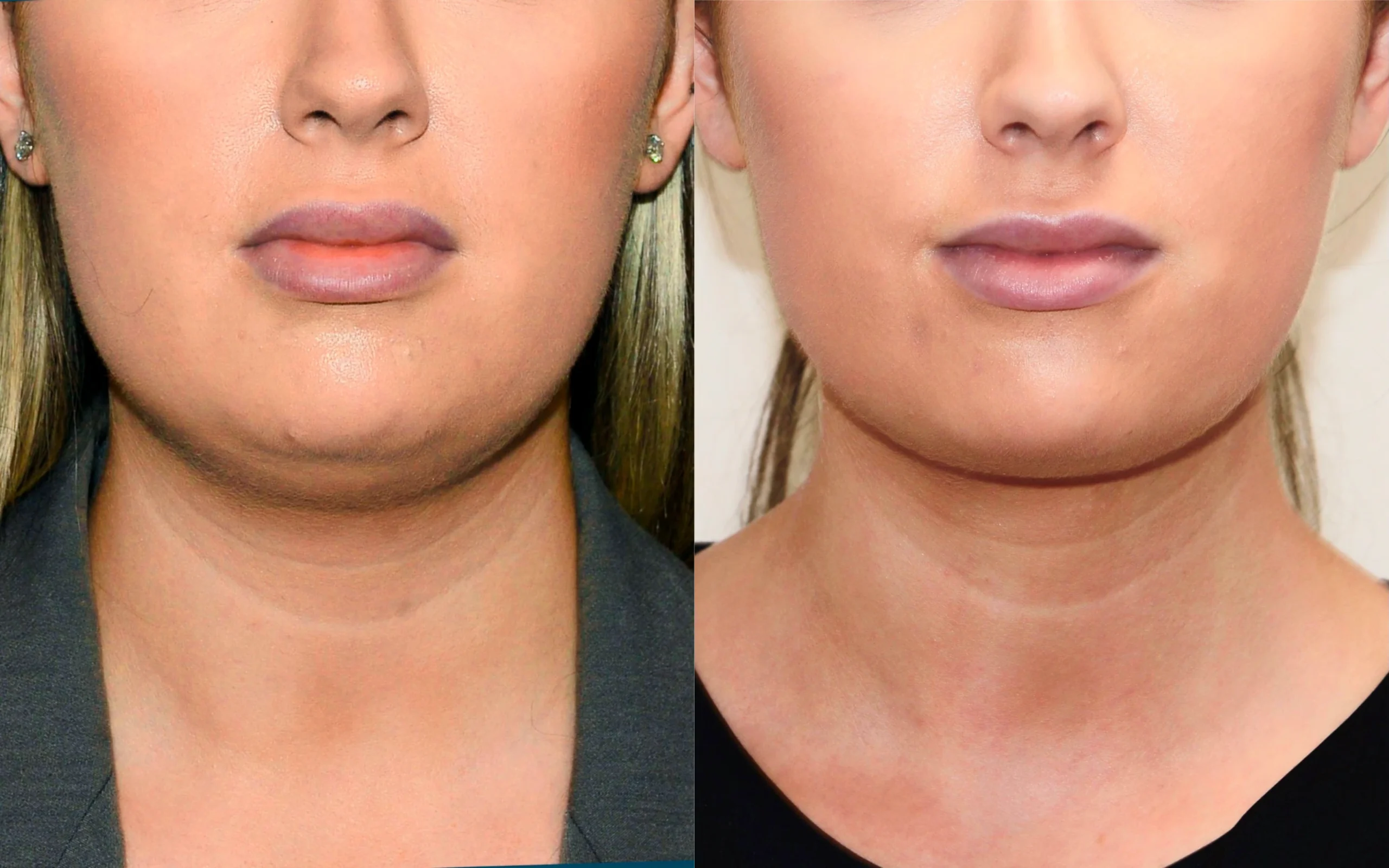 double chin removal edinburgh scotland