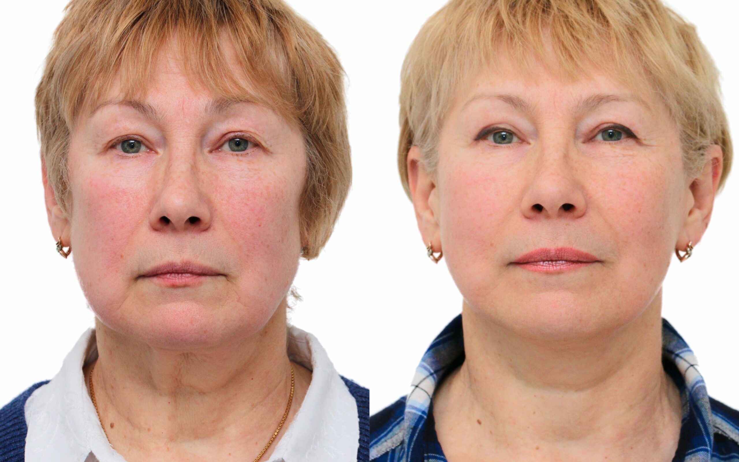 Facelift Surgery Scotland
