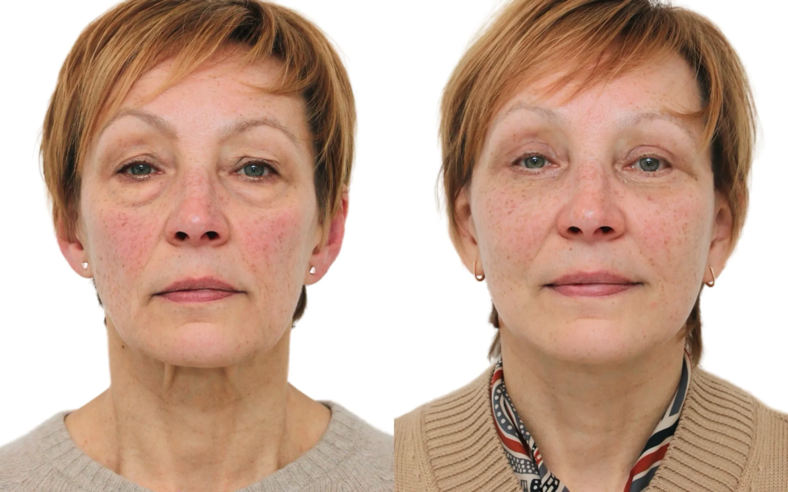 Early facelift surgery result, Edinburgh
