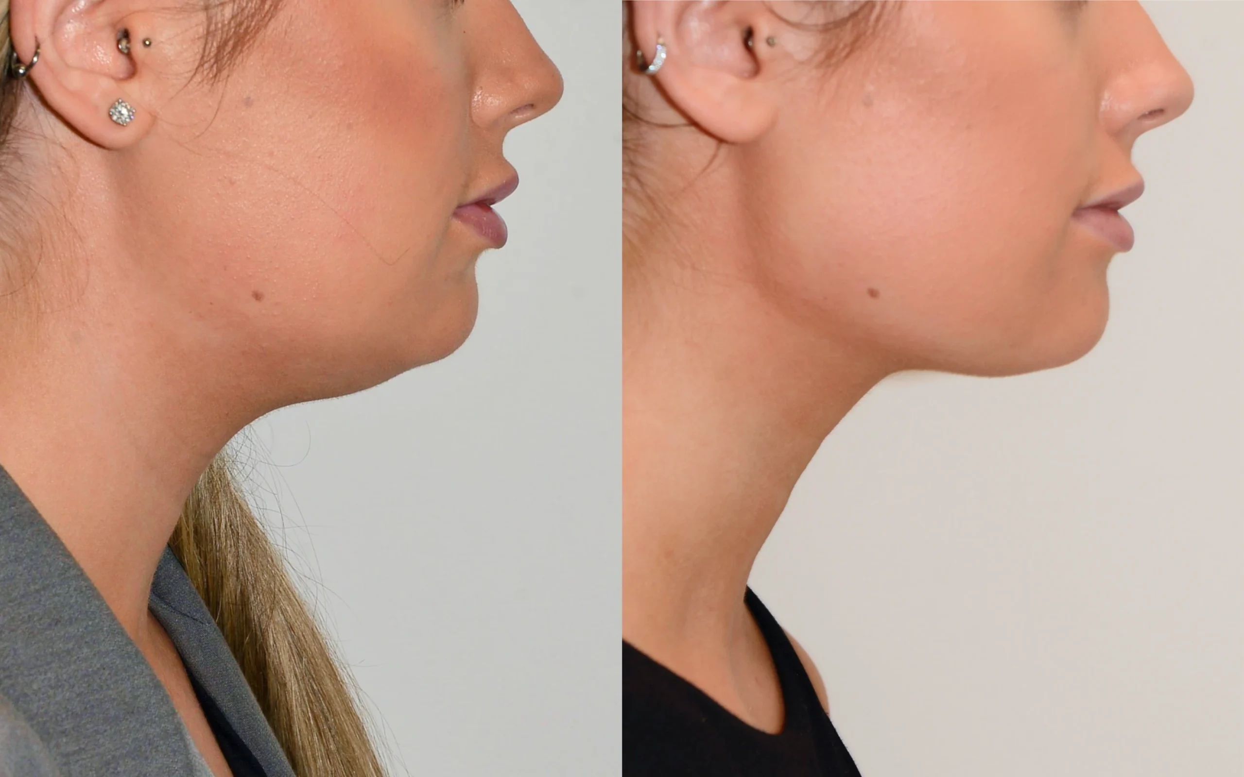 double chin removal edinburgh scotland