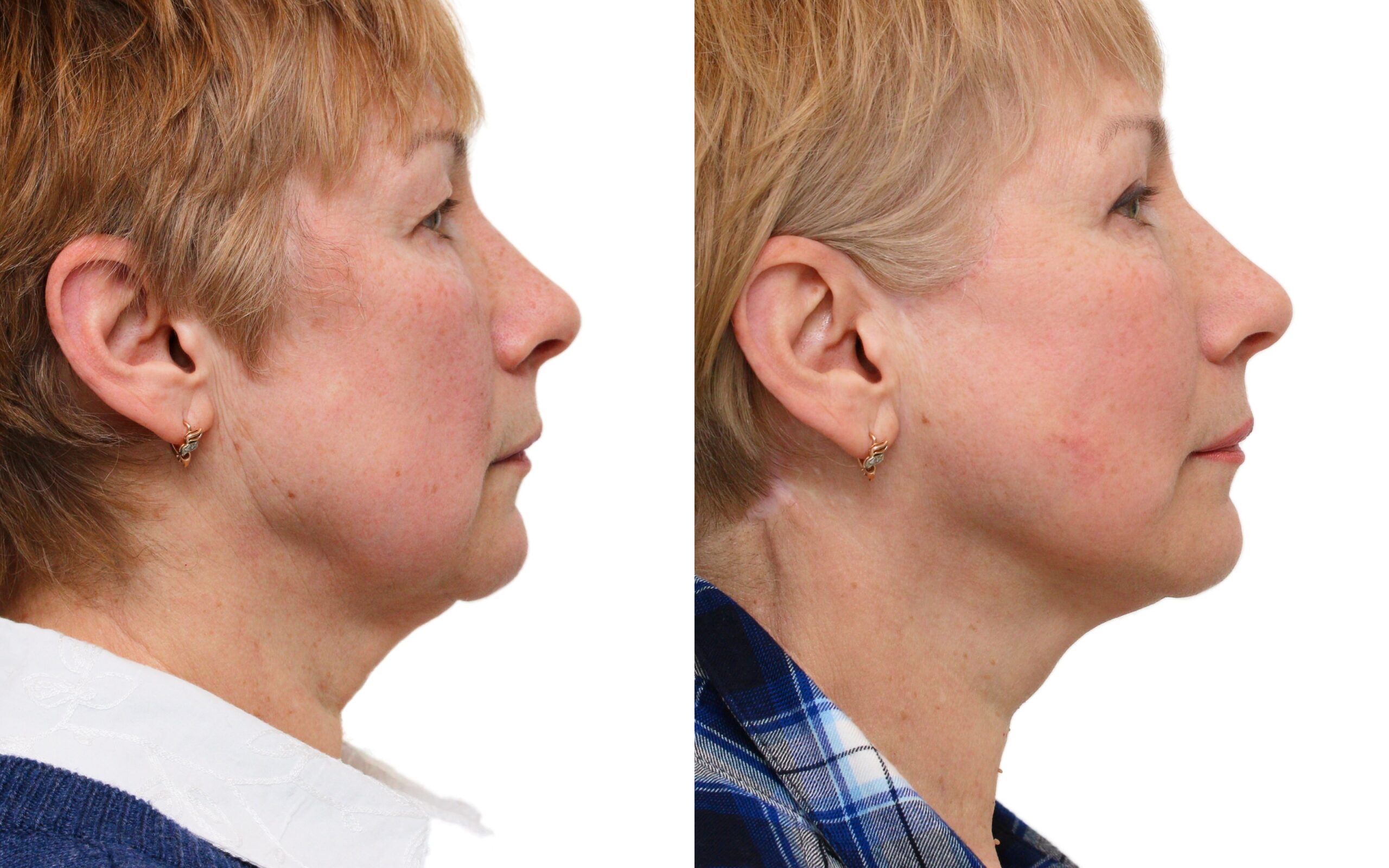 Facelift before and after — Quaba Plastic Surgery, photo 5 of 5
