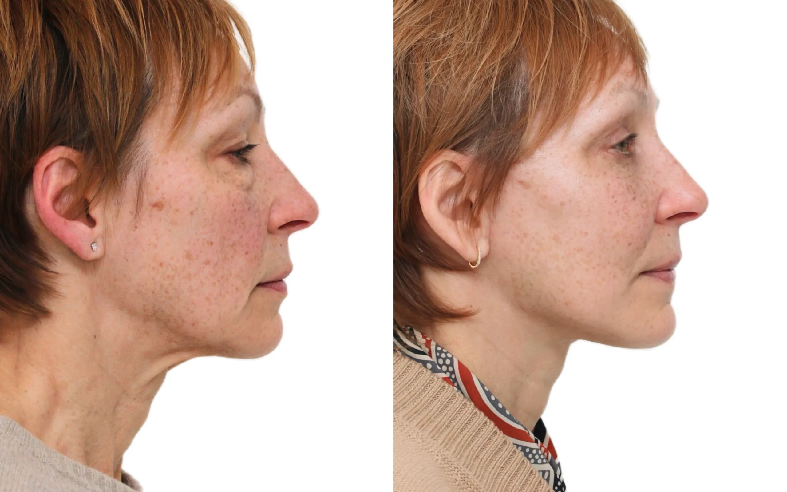 Facelift oq 5 weeks before and after — Quaba Plastic Surgery, photo 2 of 5