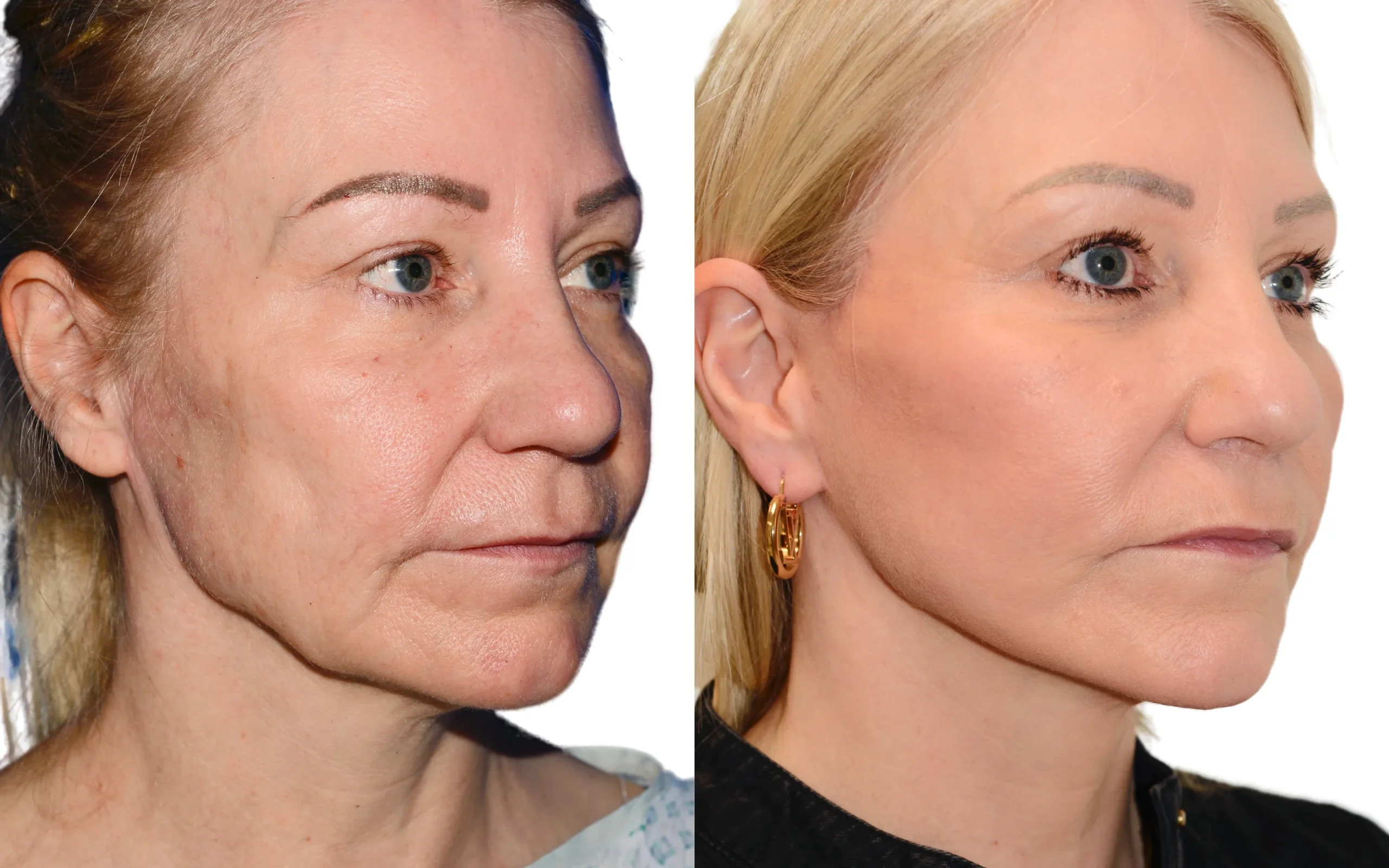 Facelift AQ fat transfer before and after — Quaba Plastic Surgery, photo 3 of 5