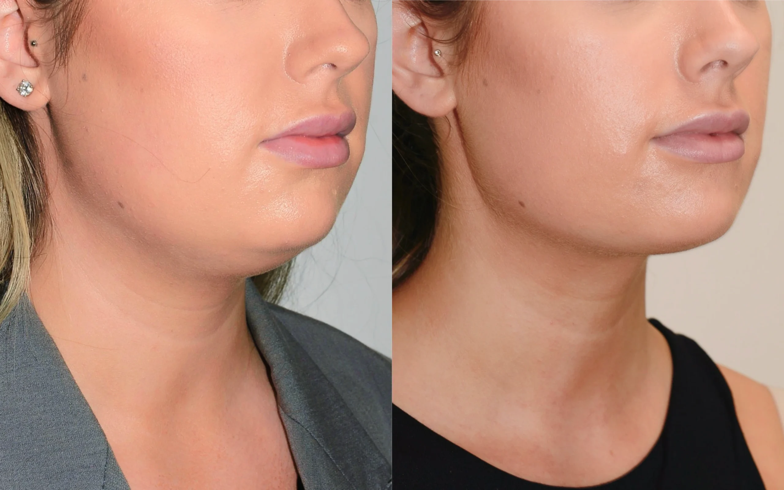 double chin removal edinburgh scotland