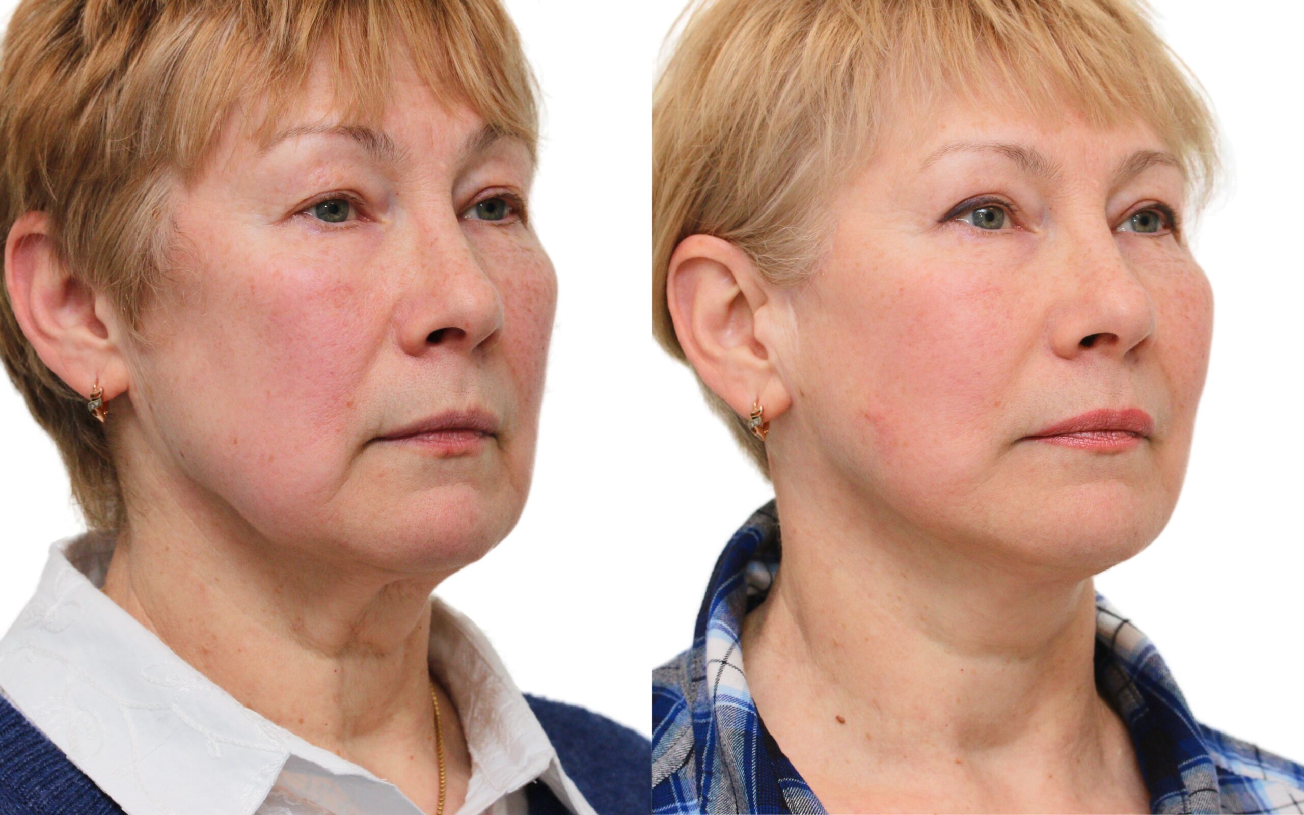 Facelift before and after — Quaba Plastic Surgery, photo 4 of 5