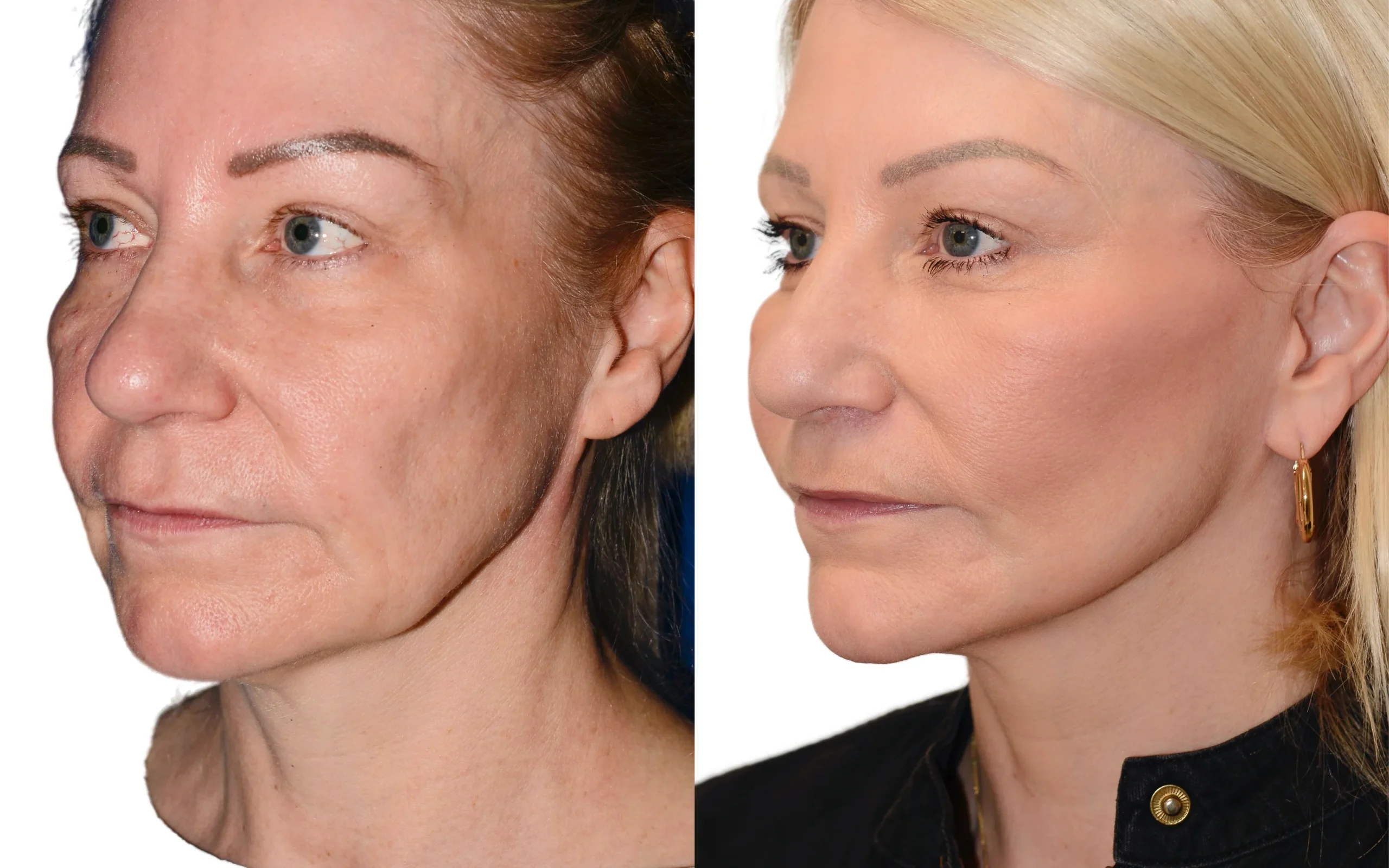 Facelift AQ fat transfer before and after — Quaba Plastic Surgery, photo 4 of 5