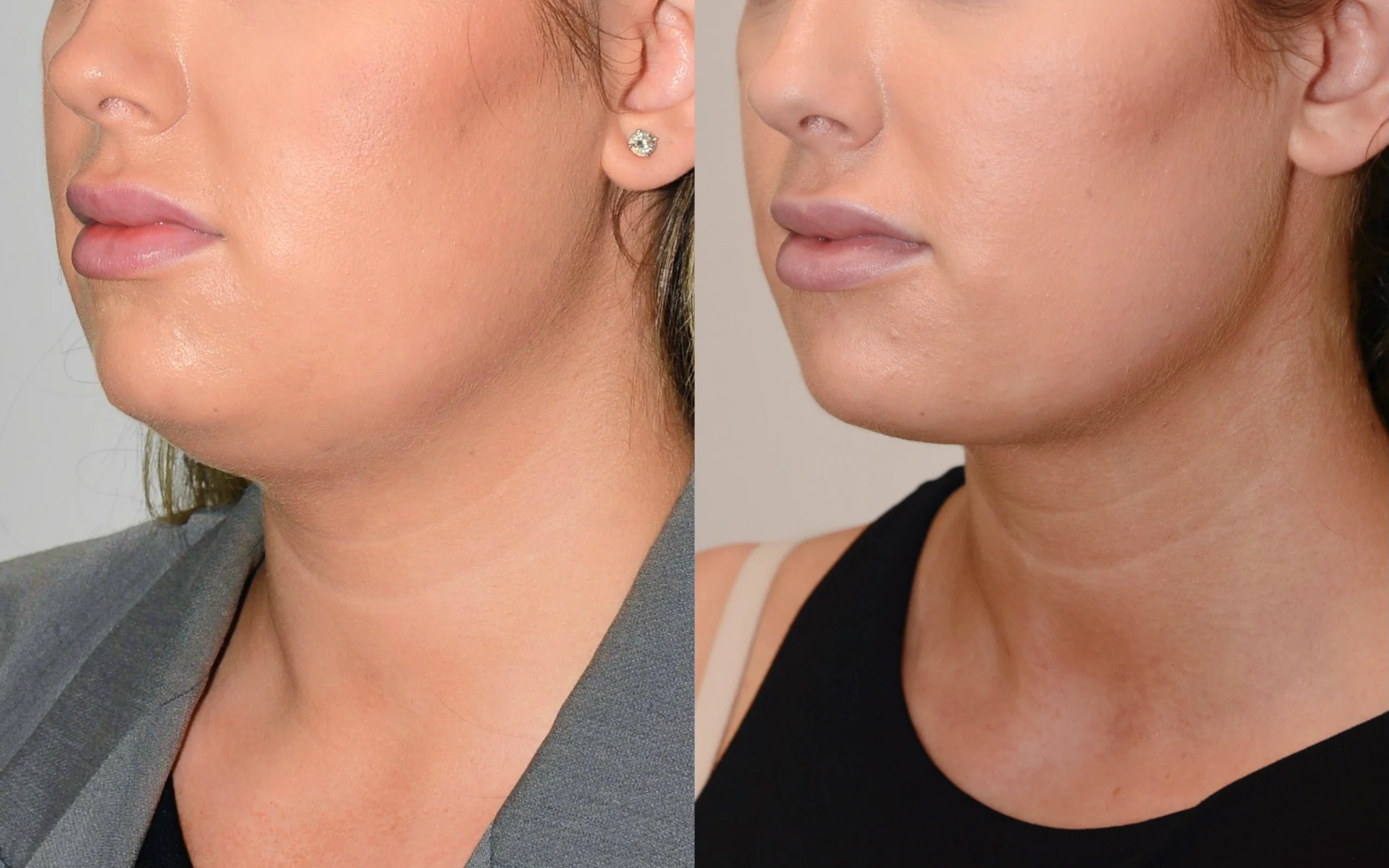 double chin removal edinburgh scotland