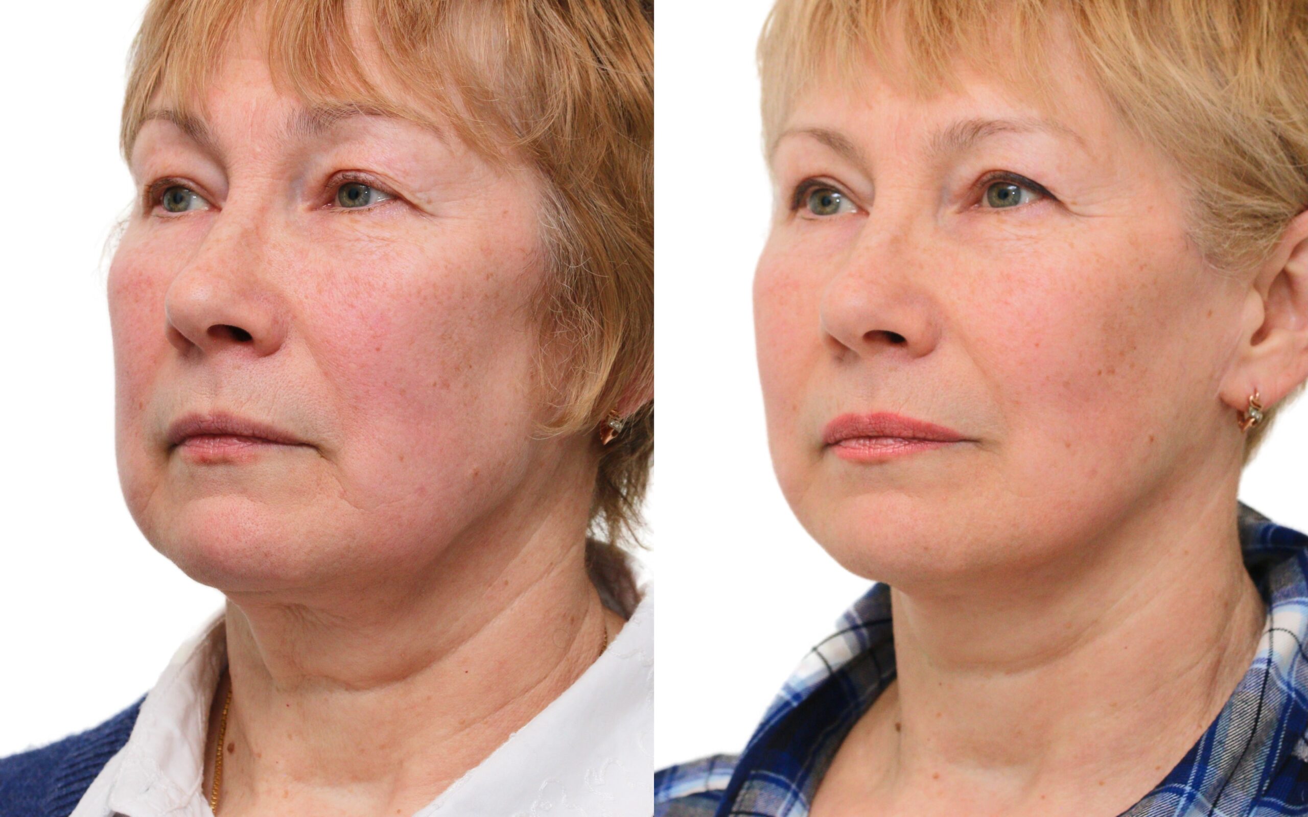 Facelift before and after — Quaba Plastic Surgery, photo 3 of 5