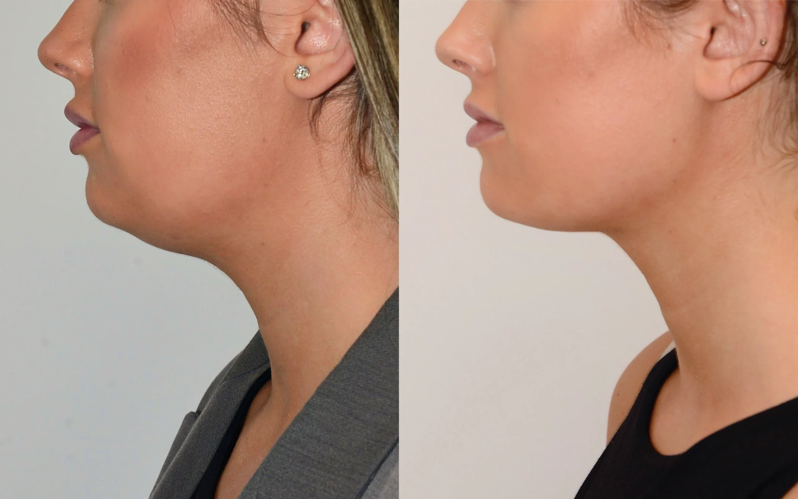 double chin removal edinburgh scotland