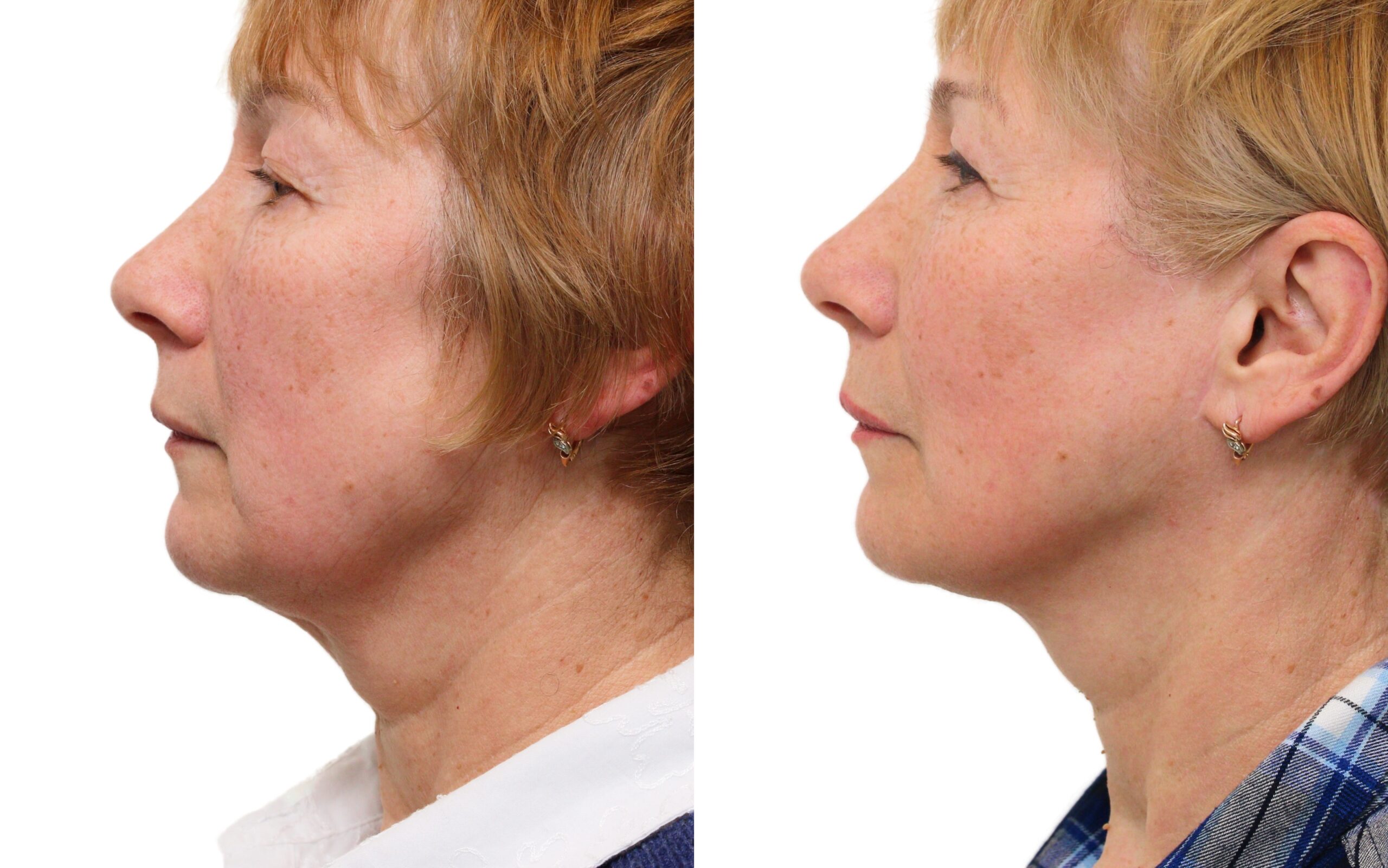 Facelift before and after — Quaba Plastic Surgery, photo 2 of 5