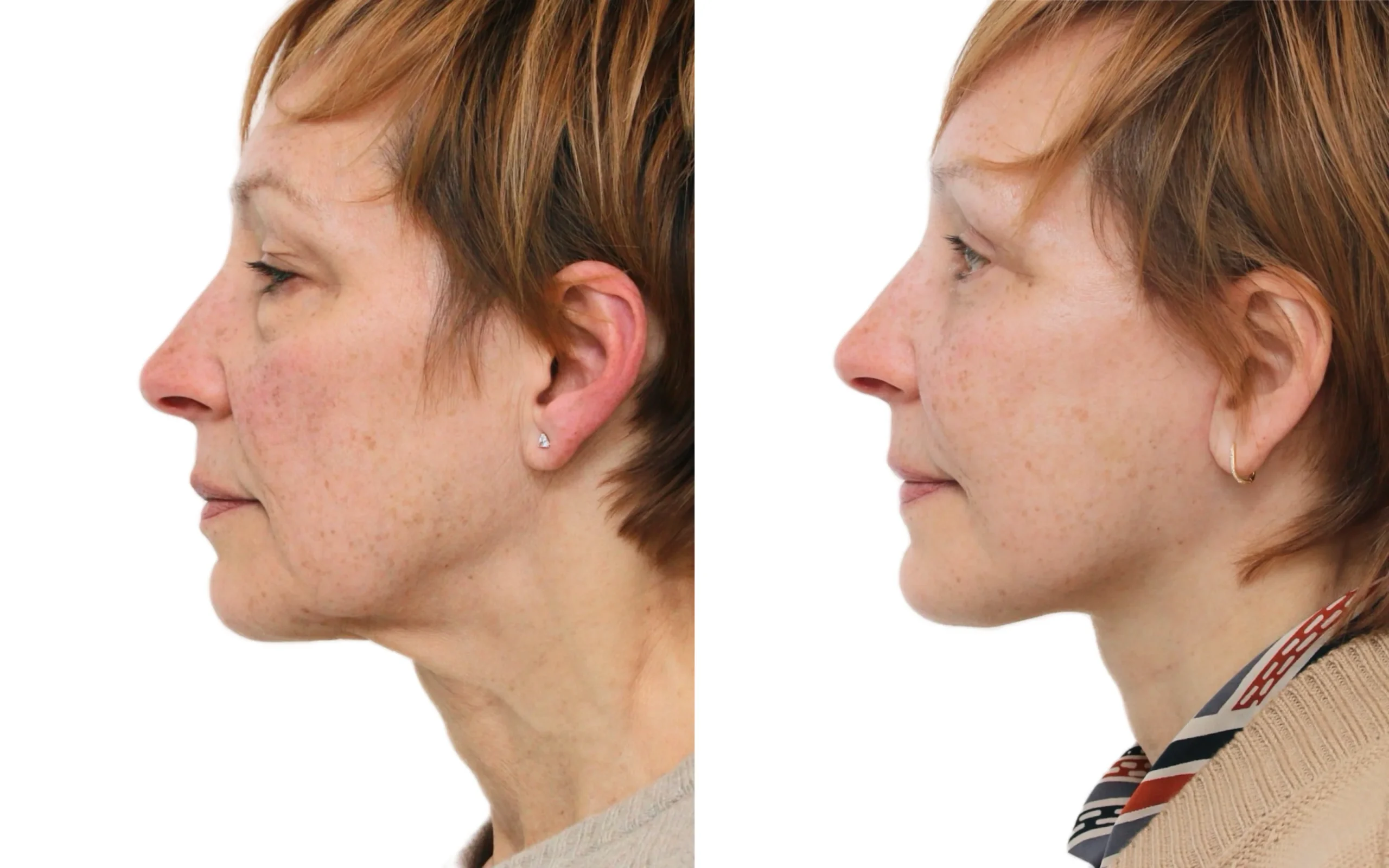 Facelift oq 5 weeks before and after — Quaba Plastic Surgery, photo 5 of 5