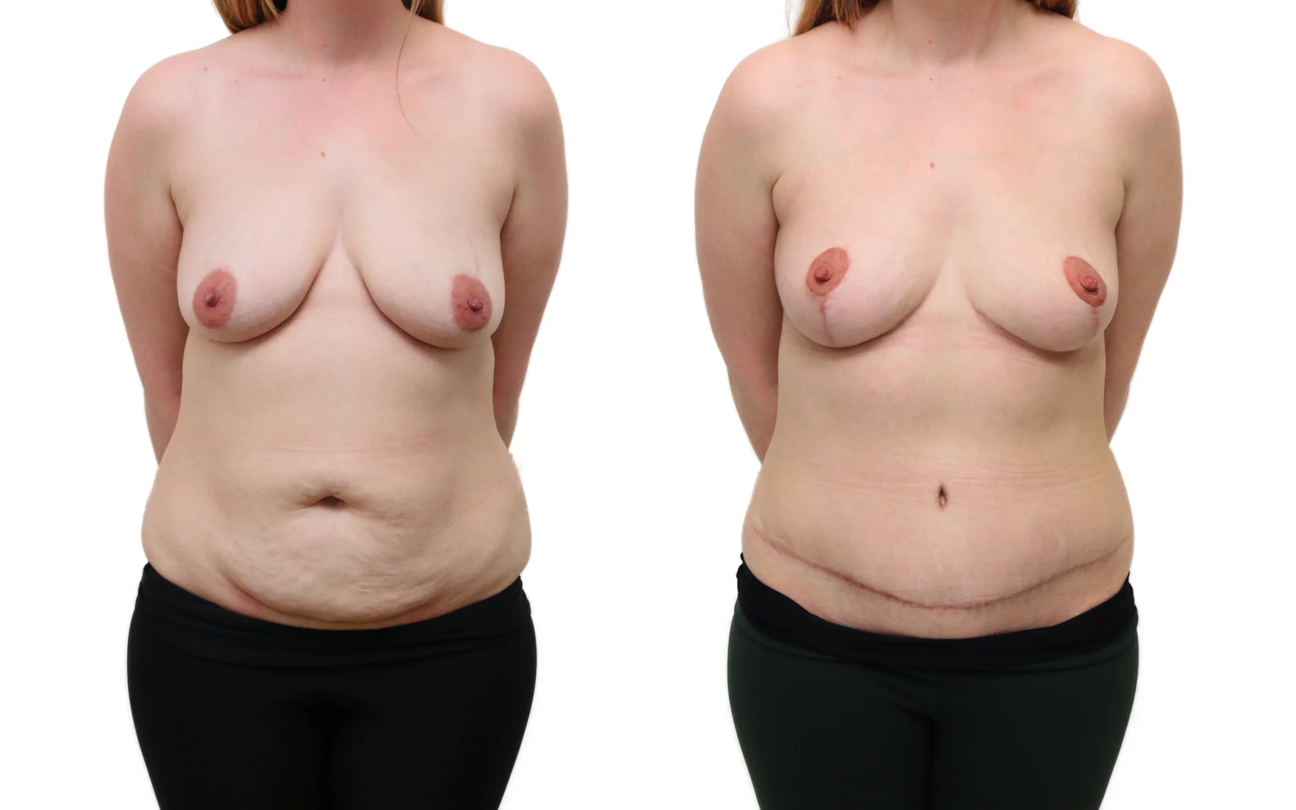 Combined Breast Uplift and Tummy Tuck After Pregnancy and Weight Loss